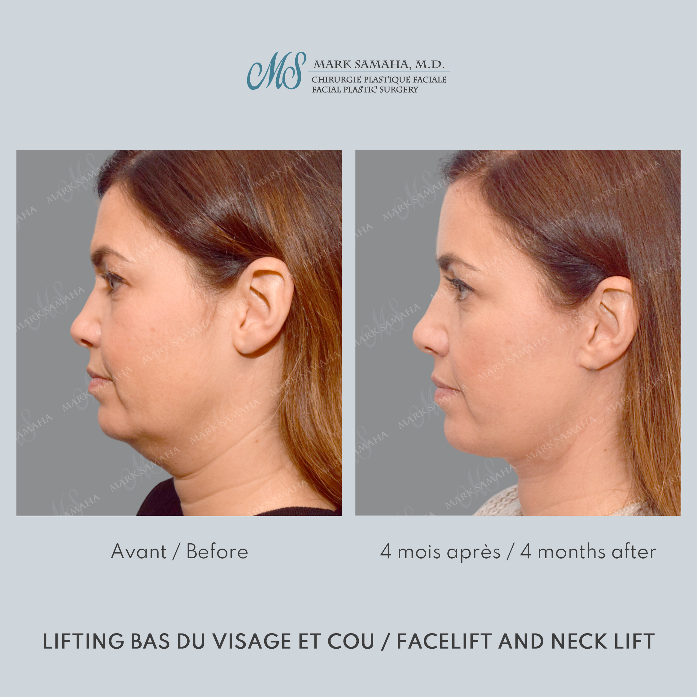 Before & After Lifting du visage / Cou - Facelift / Necklift Case 249 View #2 Detail View in Montreal, QC