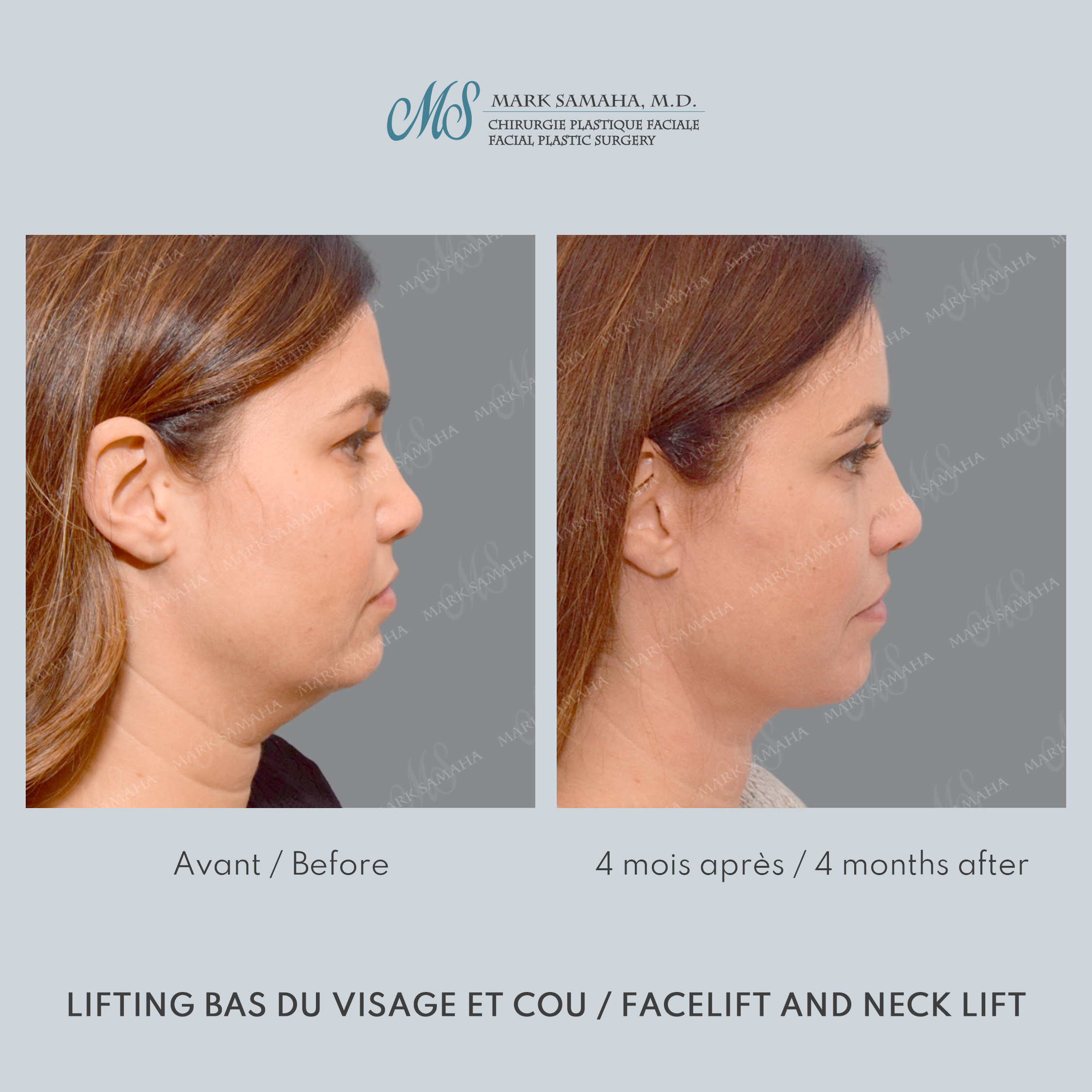 Before & After Lifting du visage / Cou - Facelift / Necklift Case 249 View #3 Detail View in Montreal, QC