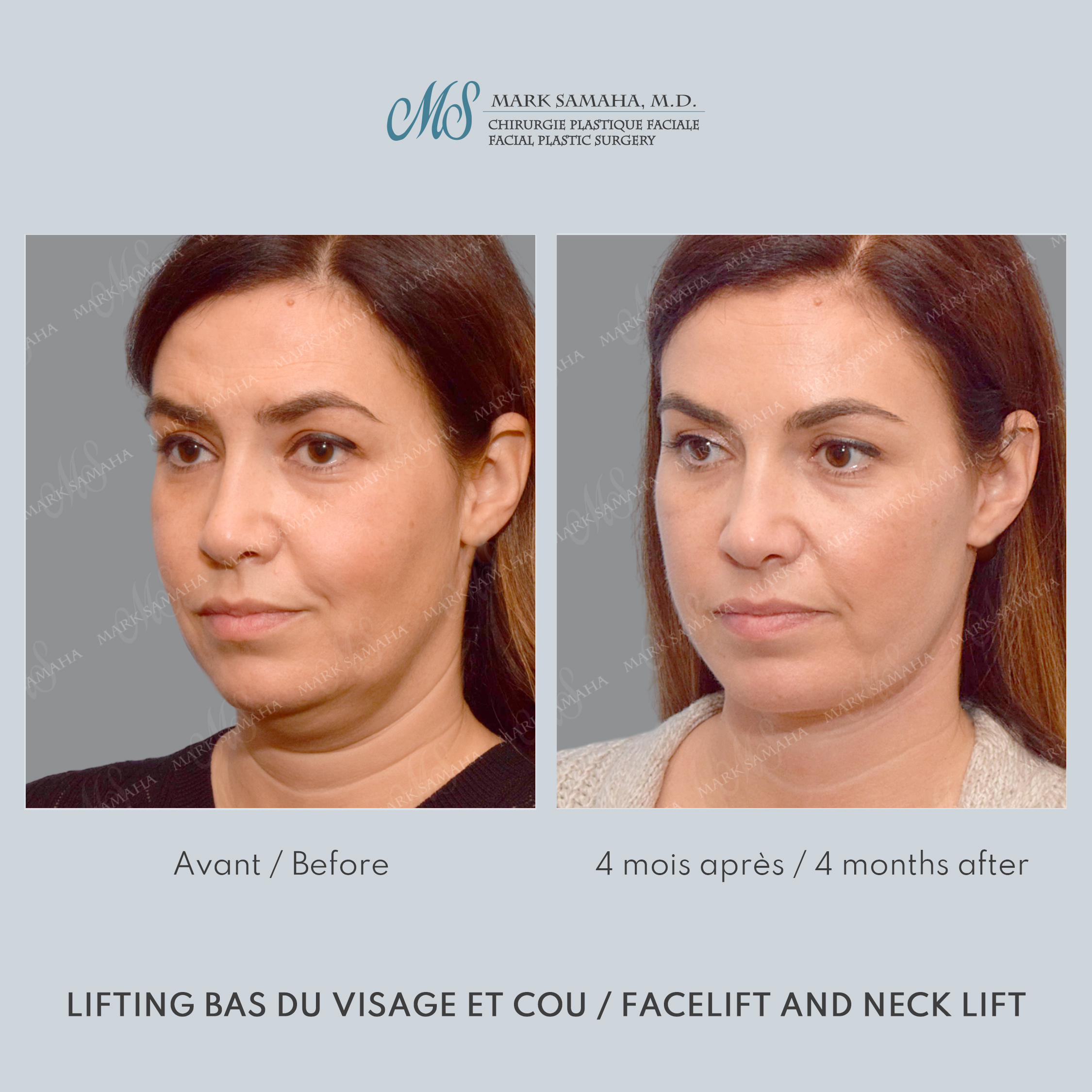 Before & After Lifting du visage / Cou - Facelift / Necklift Case 249 View #4 Detail View in Montreal, QC