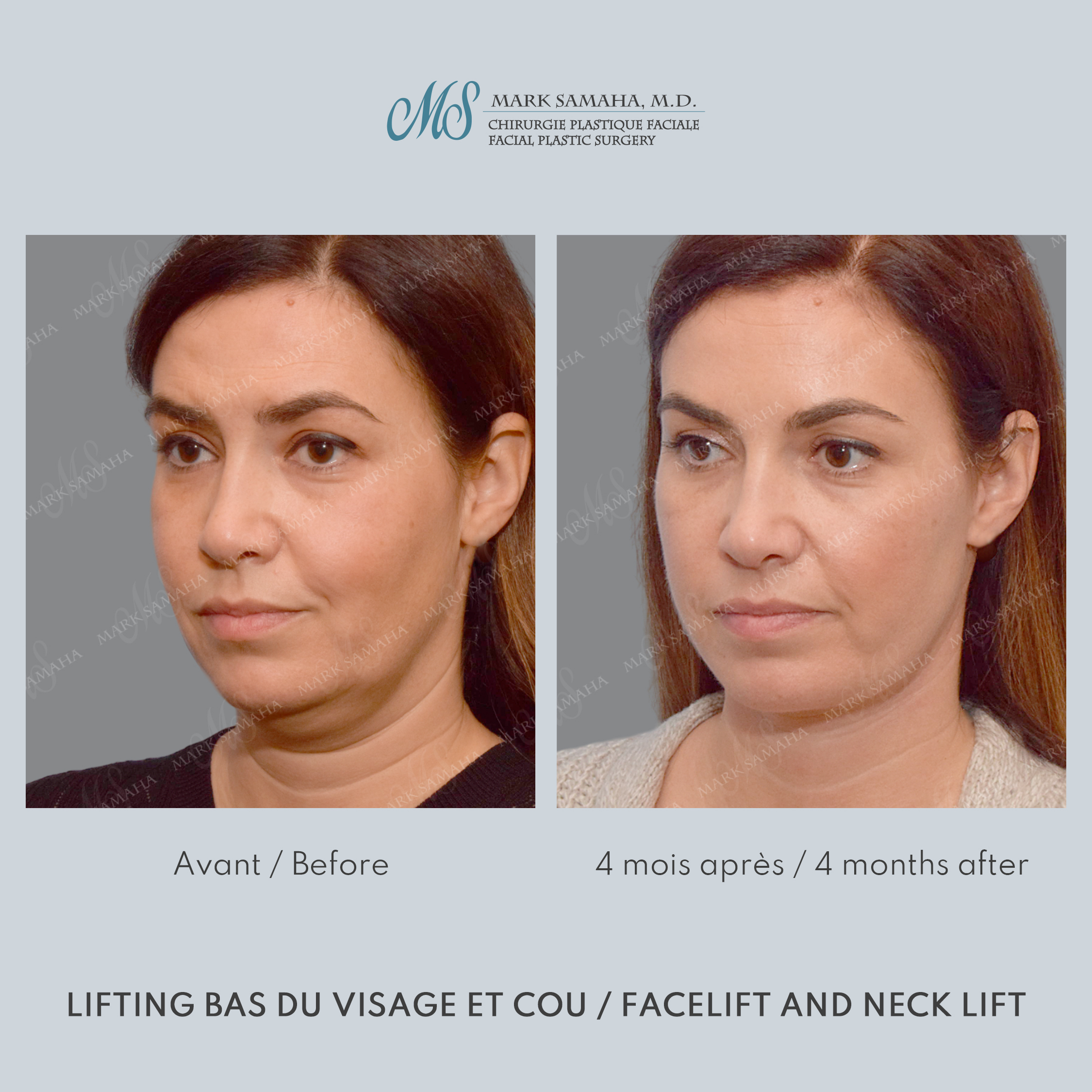Before & After Lifting du visage / Cou - Facelift / Necklift Case 249 View #4 View in Montreal, QC