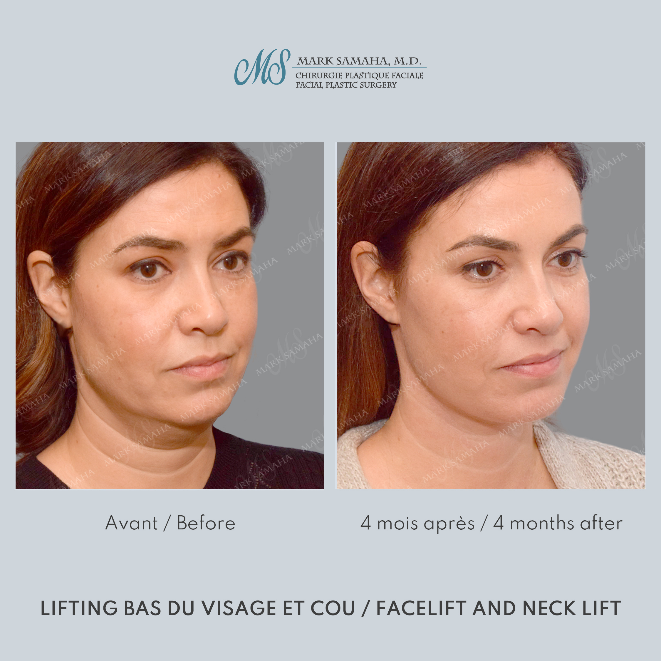 Before & After Lifting du visage / Cou - Facelift / Necklift Case 249 View #5 Detail View in Montreal, QC