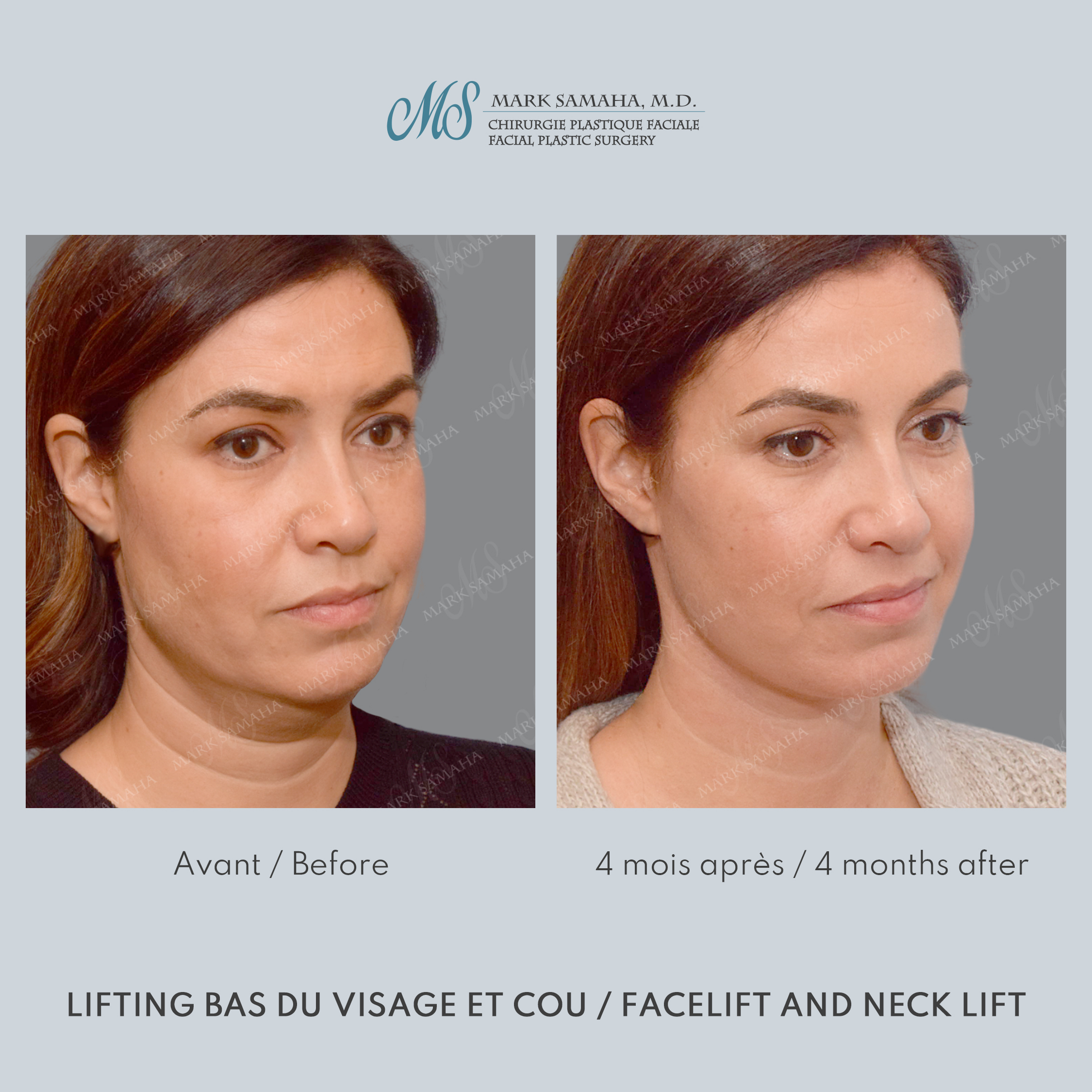 Before & After Lifting du visage / Cou - Facelift / Necklift Case 249 View #5 View in Montreal, QC