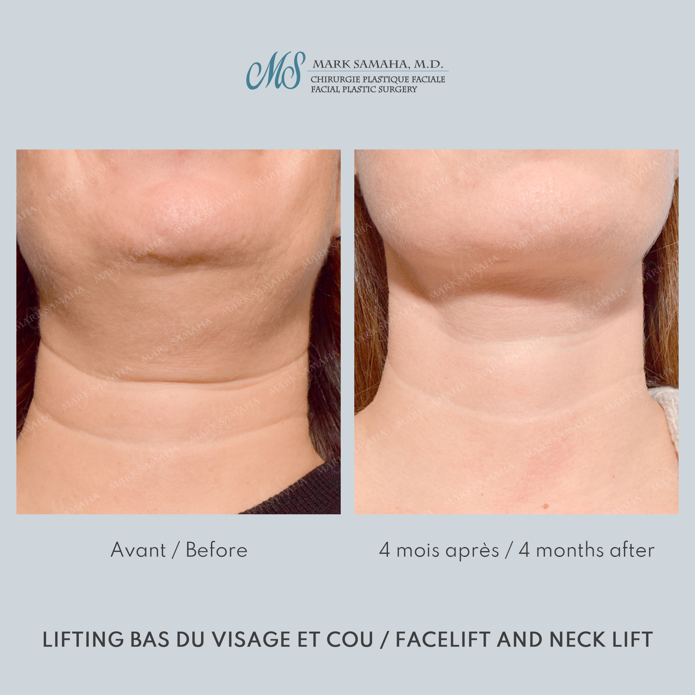 Before & After Lifting du visage / Cou - Facelift / Necklift Case 249 View #6 Detail View in Montreal, QC