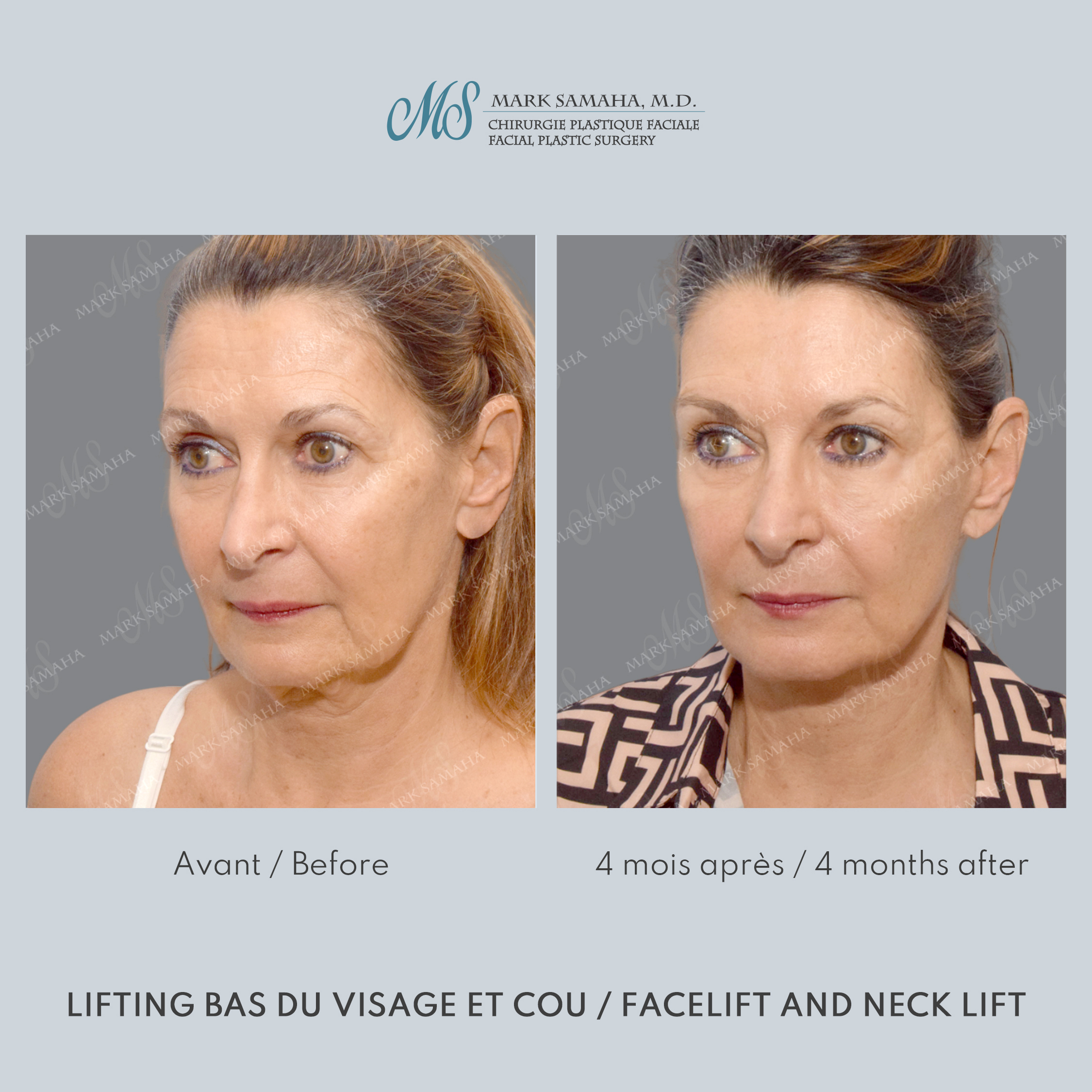 Before & After Lifting du visage / Cou - Facelift / Necklift Case 250 View #1 Detail View in Montreal, QC