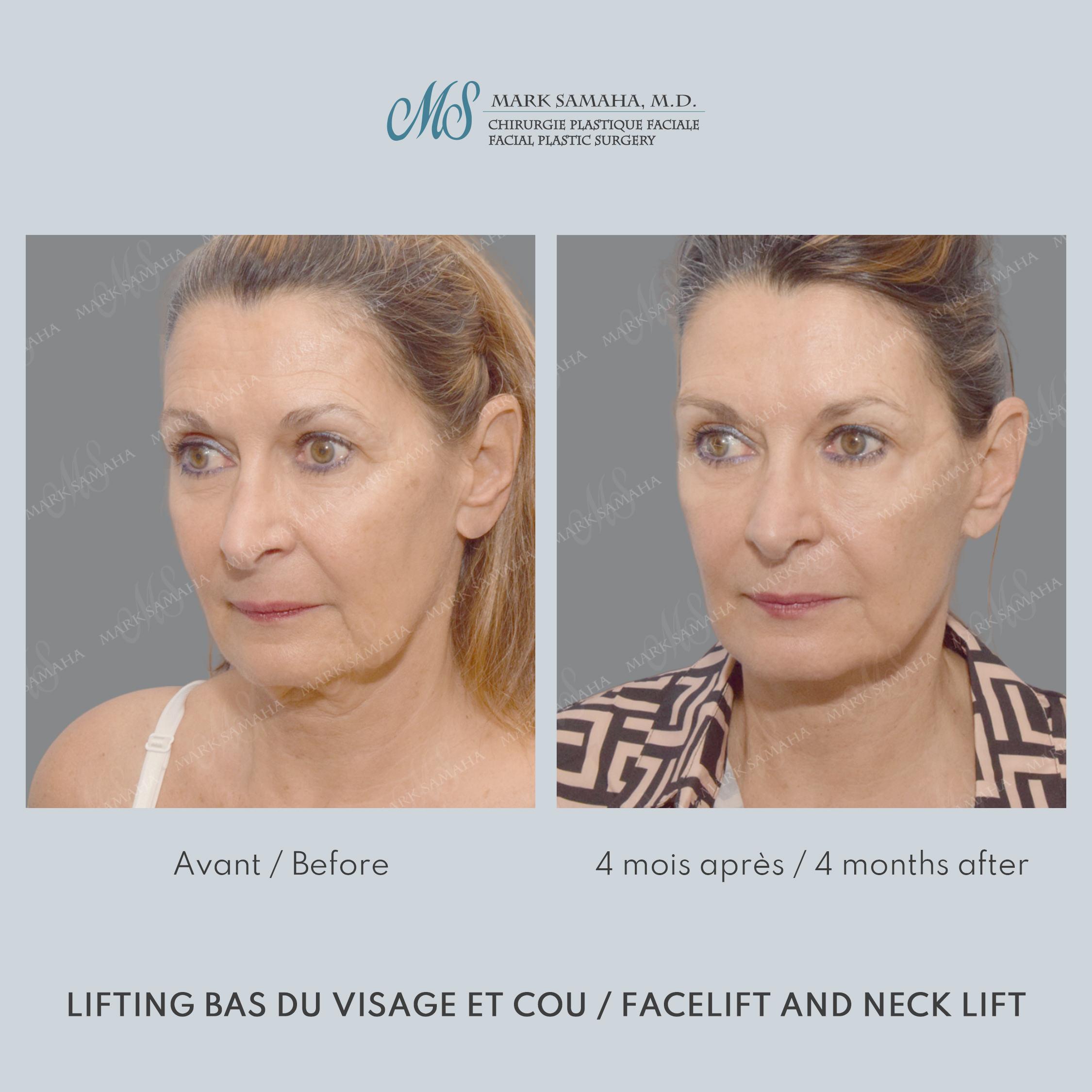 Before & After Lifting du visage / Cou - Facelift / Necklift Case 250 View #1 View in Montreal, QC