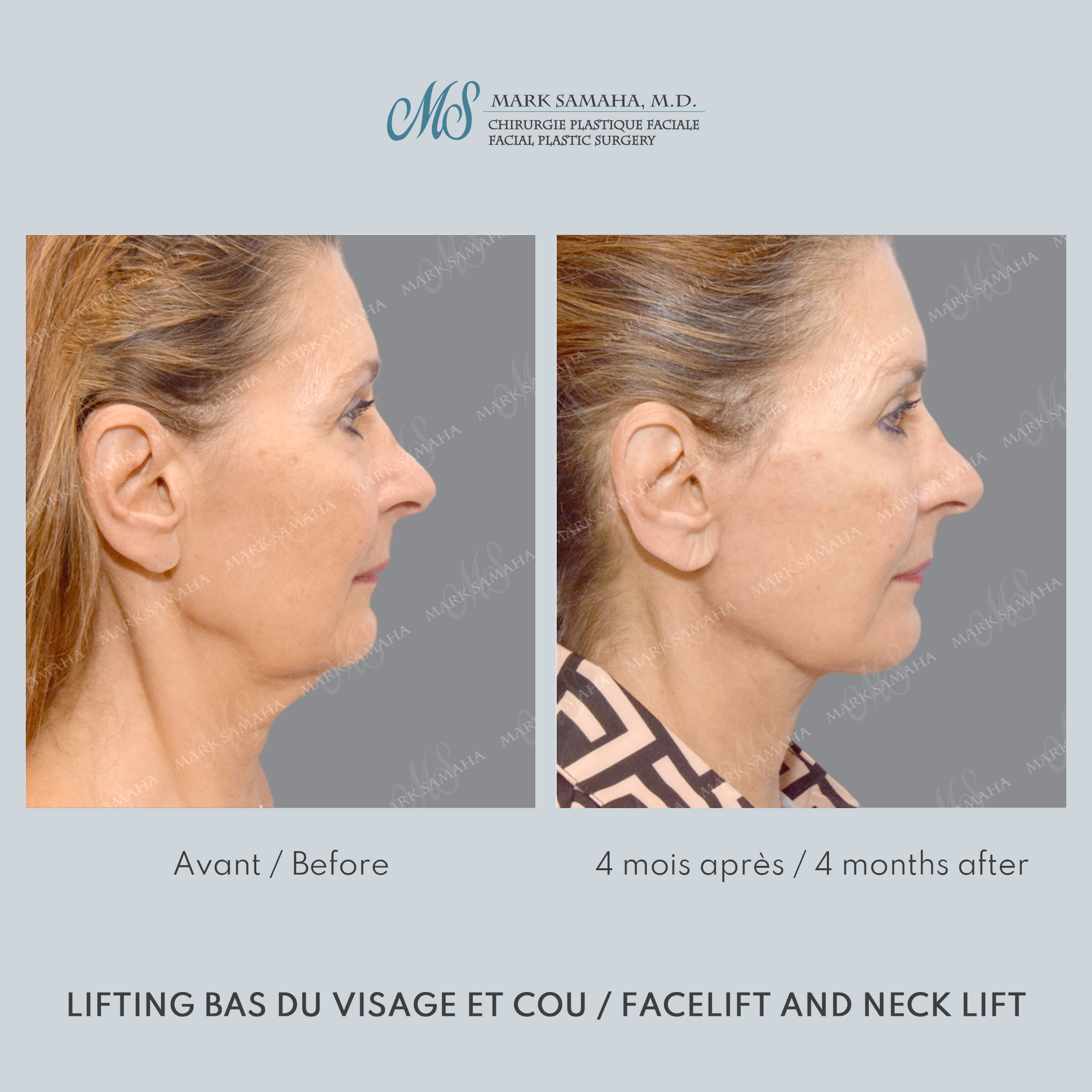 Before & After Lifting du visage / Cou - Facelift / Necklift Case 250 View #2 Detail View in Montreal, QC