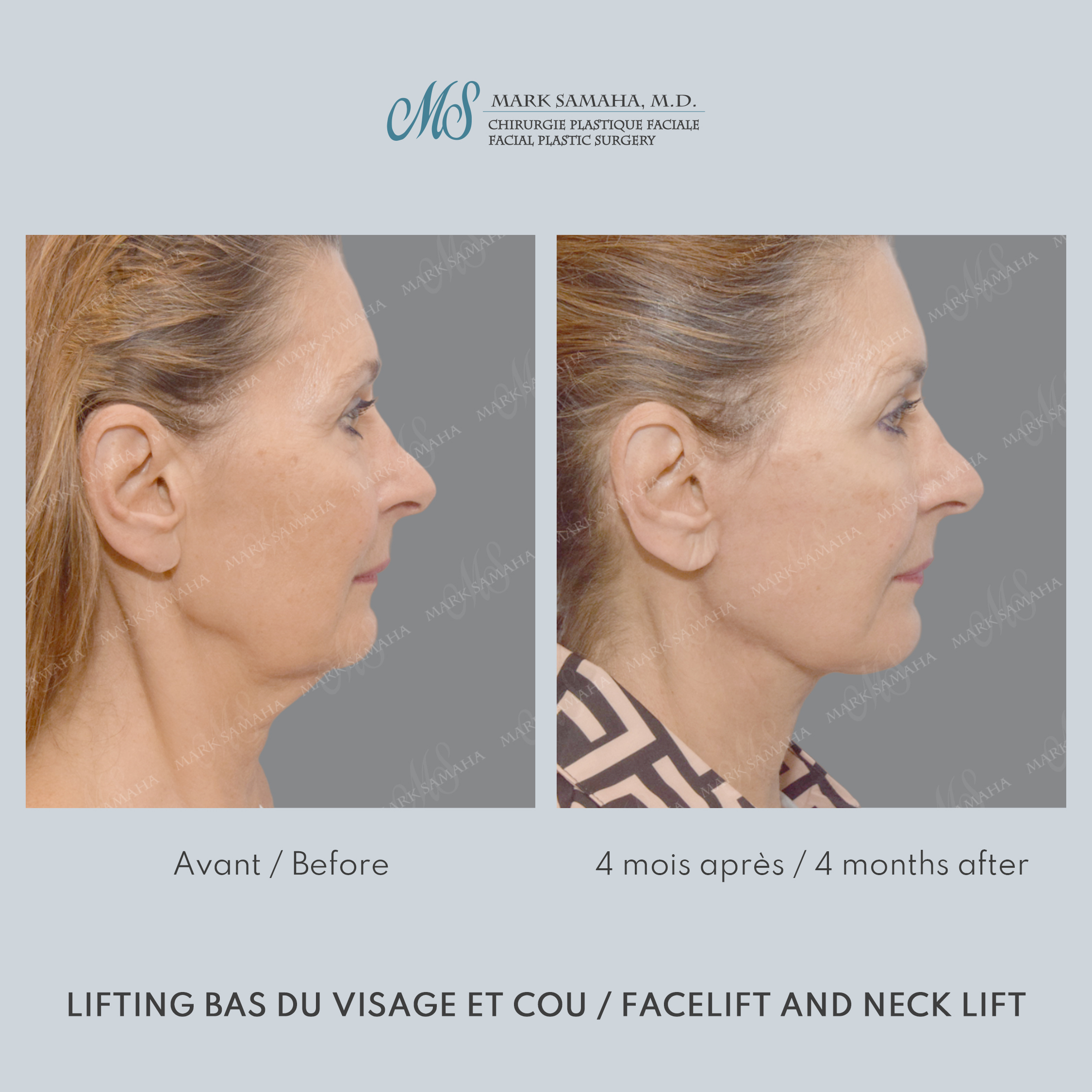 Before & After Lifting du visage / Cou - Facelift / Necklift Case 250 View #2 View in Montreal, QC