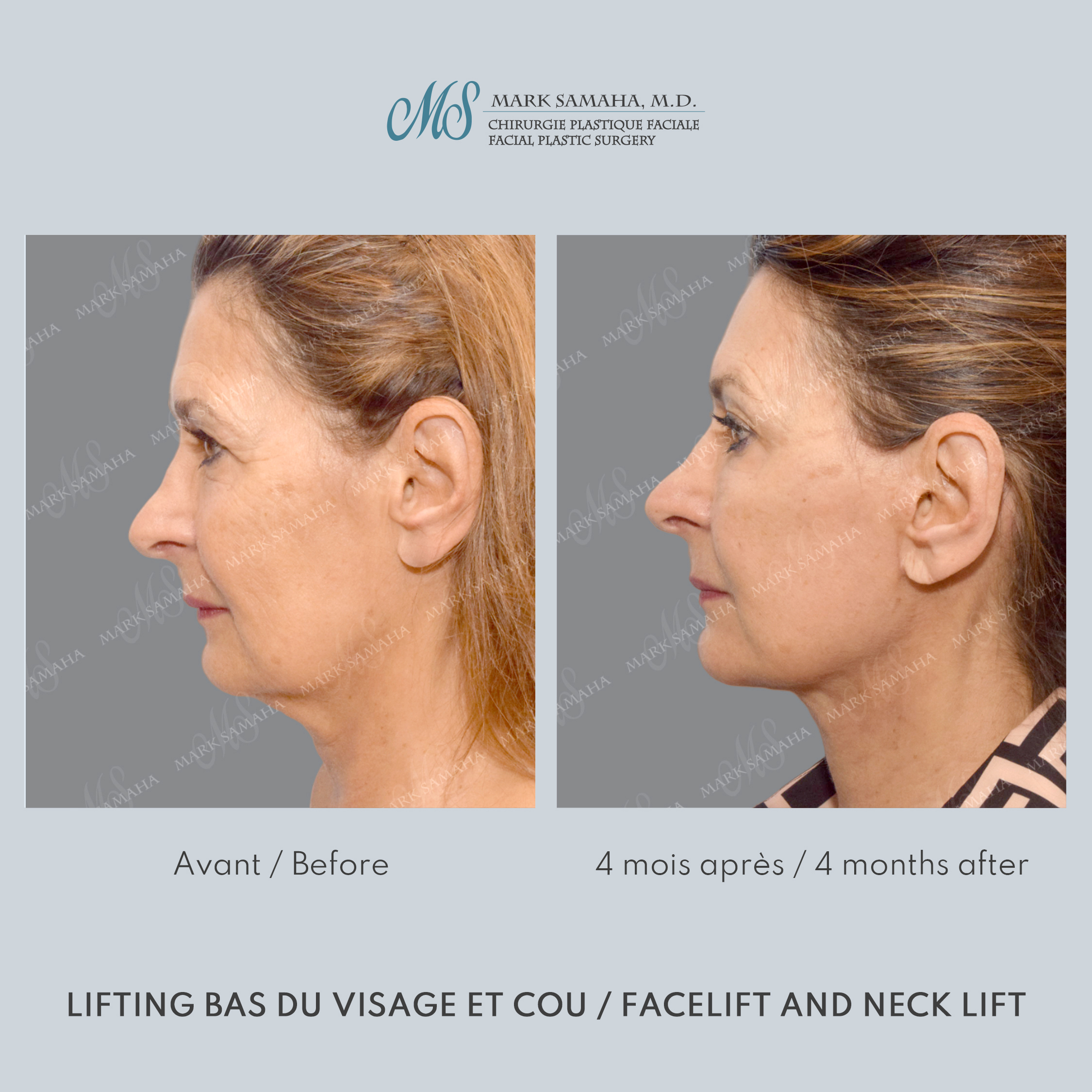 Before & After Lifting du visage / Cou - Facelift / Necklift Case 250 View #3 Detail View in Montreal, QC