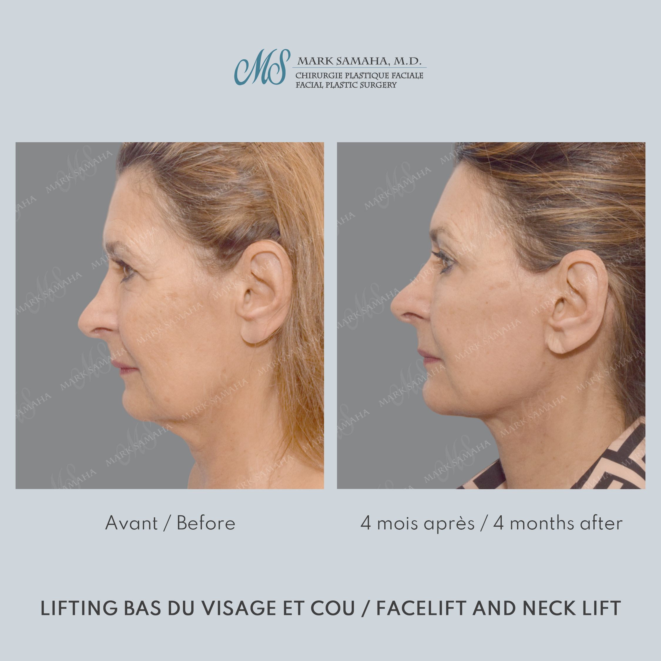 Before & After Lifting du visage / Cou - Facelift / Necklift Case 250 View #3 View in Montreal, QC