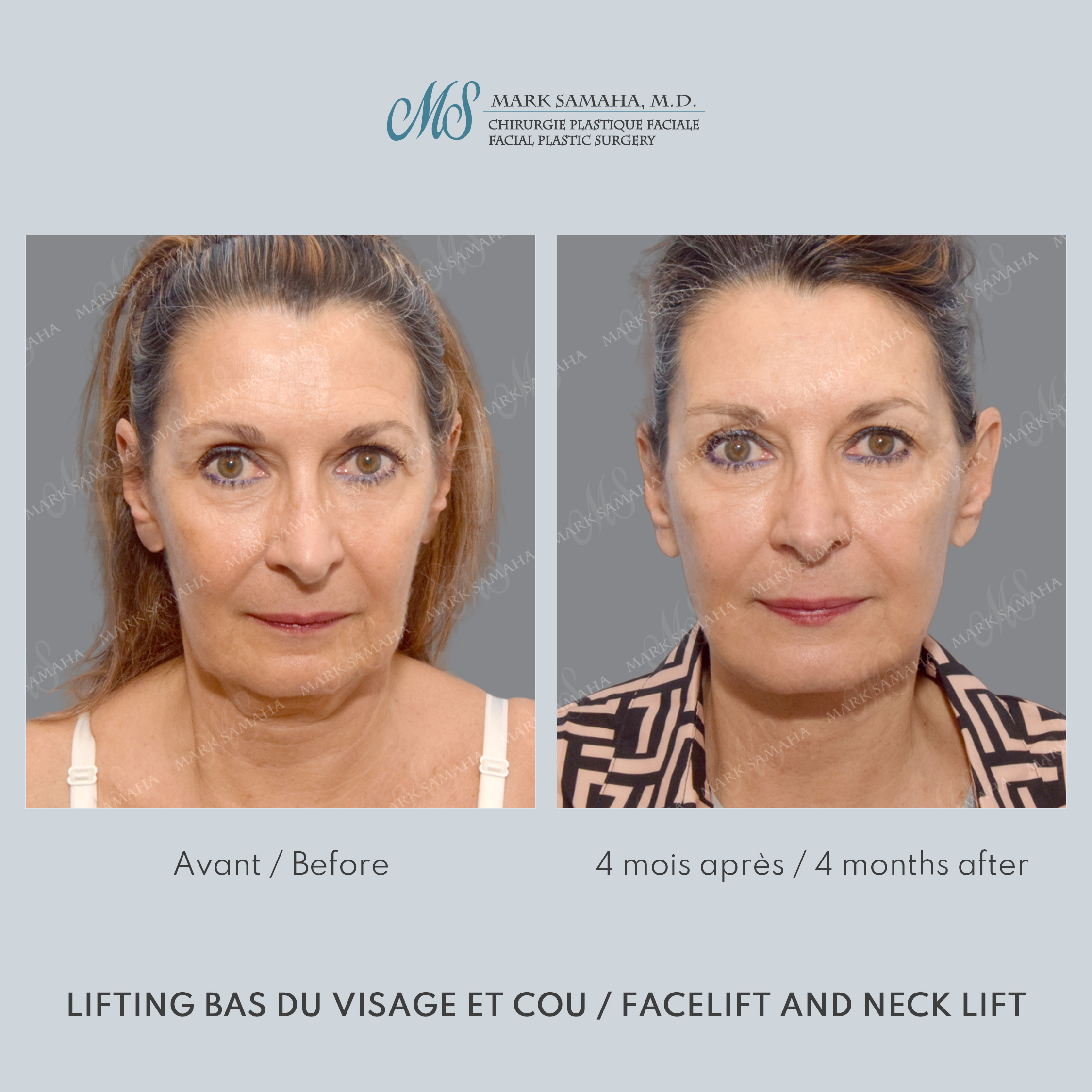 Before & After Lifting du visage / Cou - Facelift / Necklift Case 250 View #4 Detail View in Montreal, QC