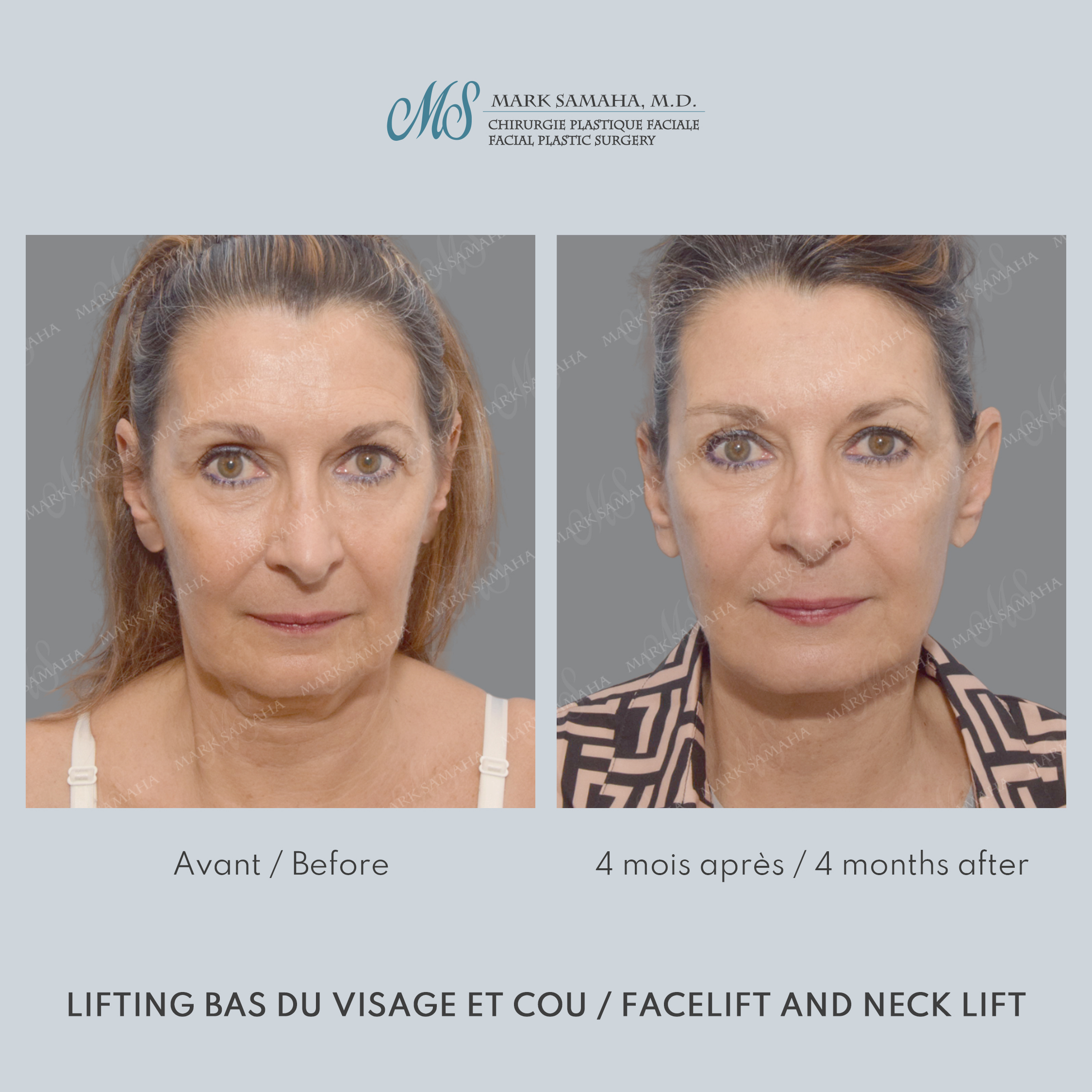 Before & After Lifting du visage / Cou - Facelift / Necklift Case 250 View #4 View in Montreal, QC