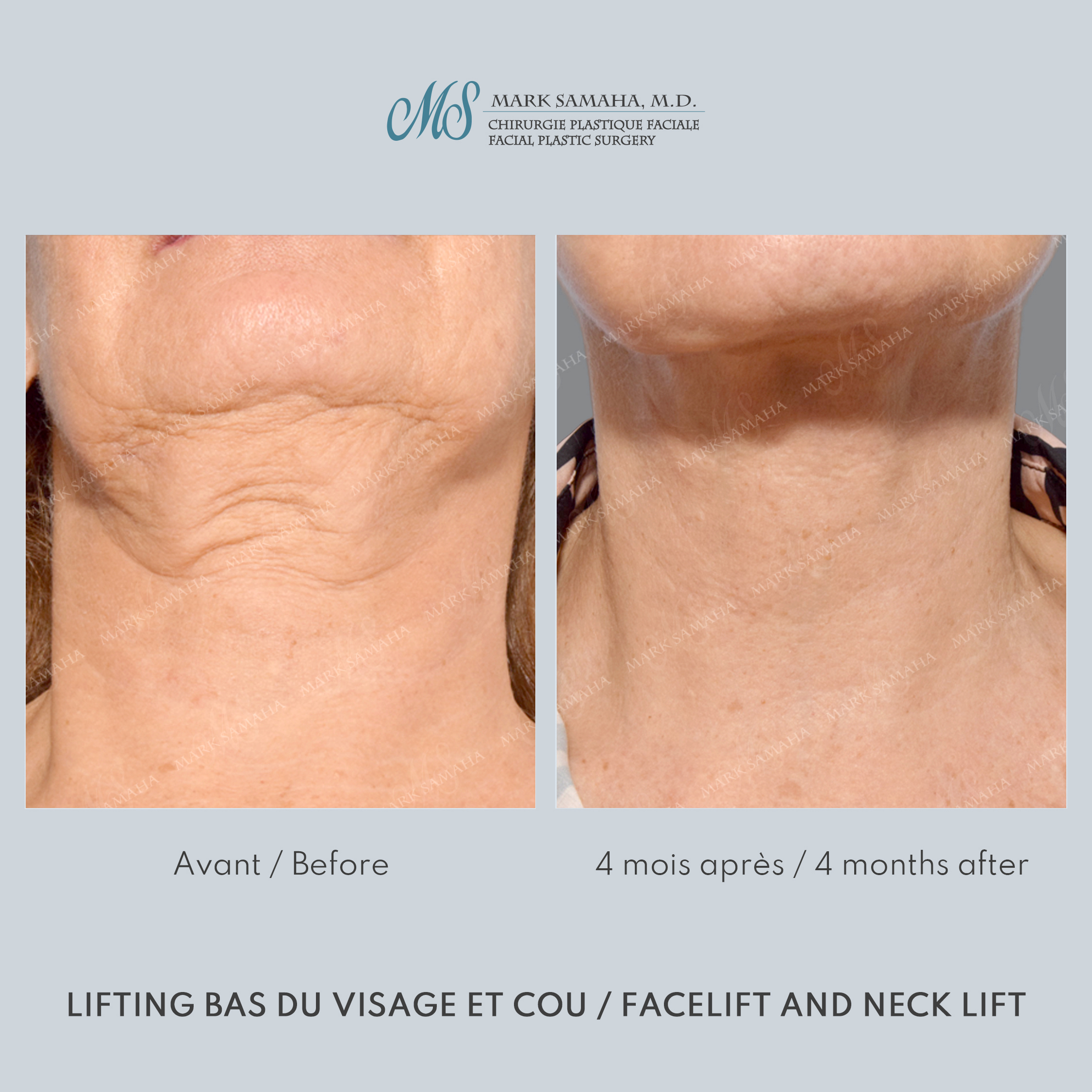 Before & After Lifting du visage / Cou - Facelift / Necklift Case 250 View #5 Detail View in Montreal, QC