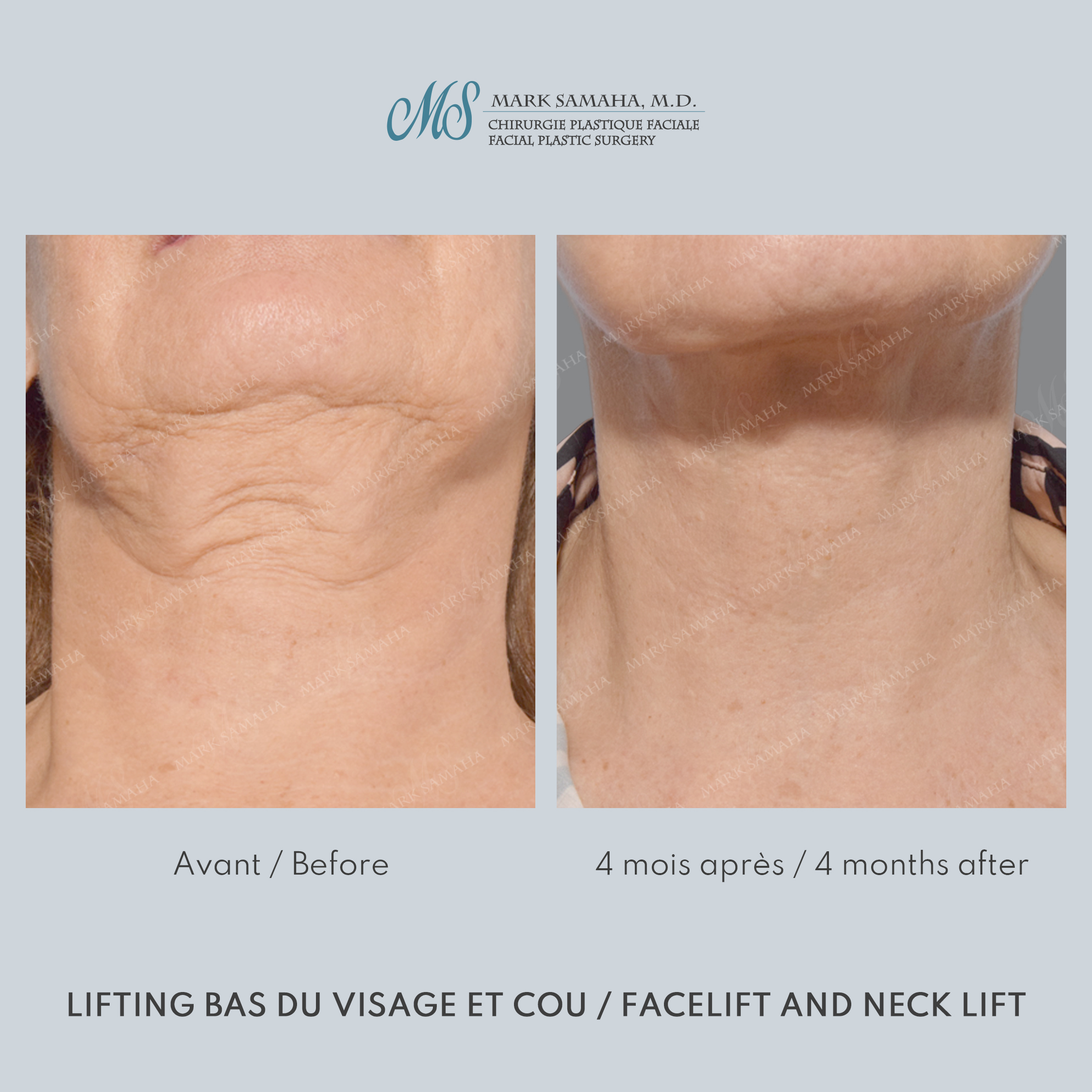Before & After Lifting du visage / Cou - Facelift / Necklift Case 250 View #5 View in Montreal, QC