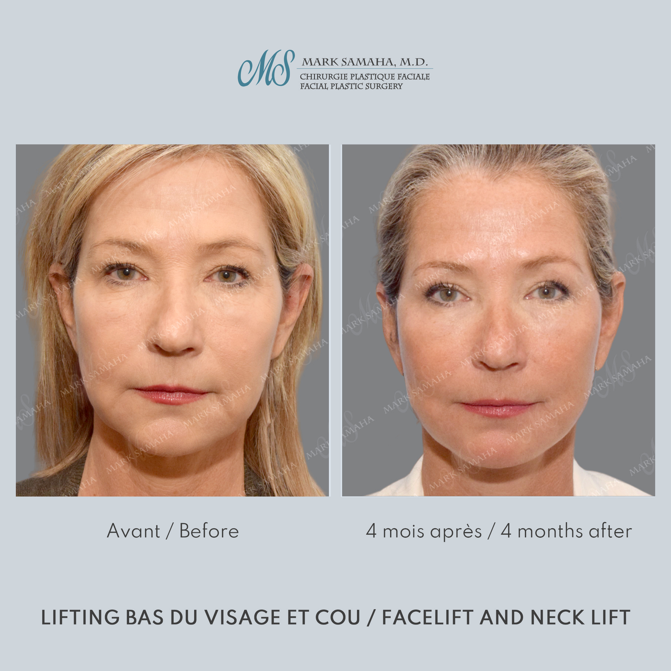 Before & After Lifting du visage / Cou - Facelift / Necklift Case 251 View #1 Detail View in Montreal, QC