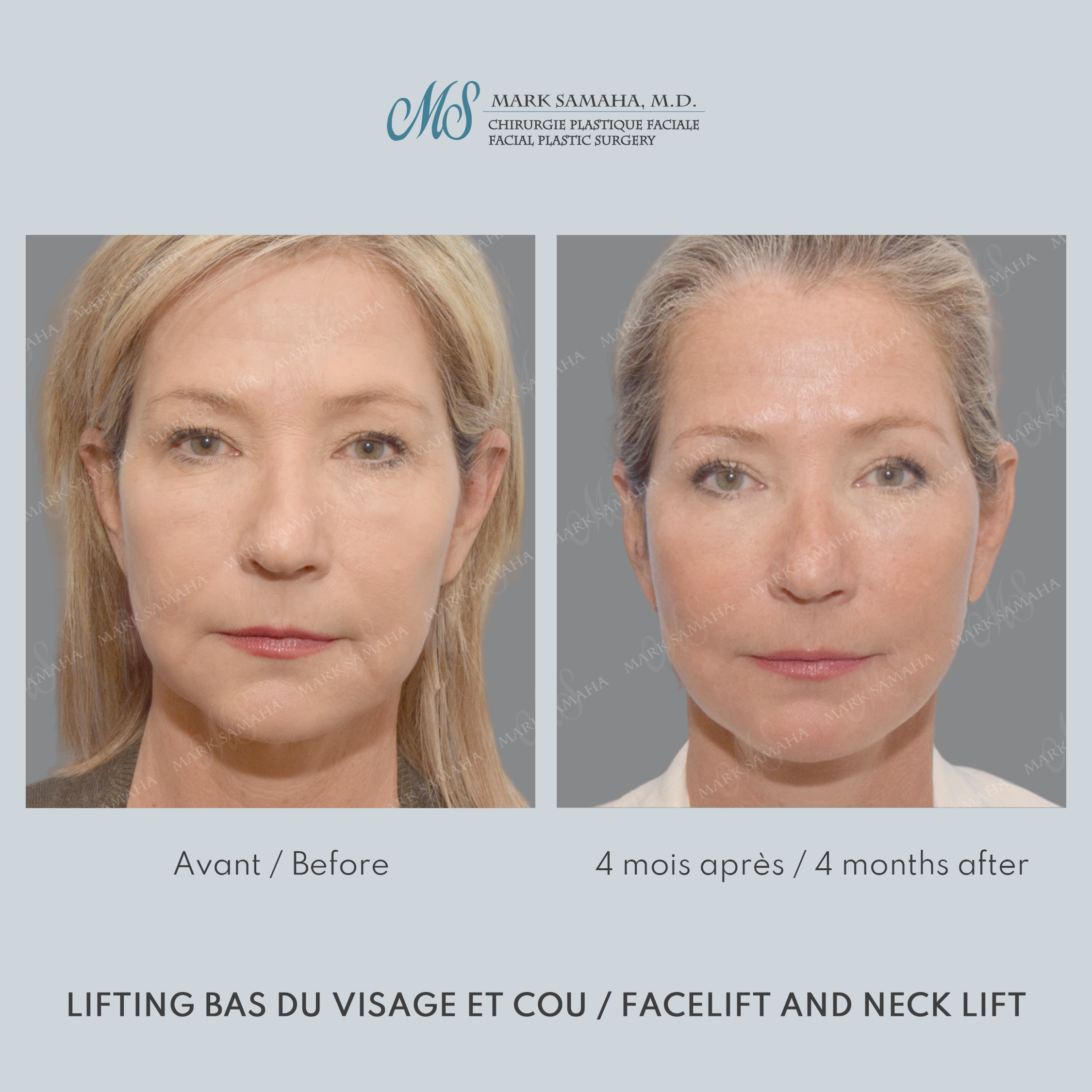 Before & After Lifting du visage / Cou - Facelift / Necklift Case 251 View #1 View in Montreal, QC