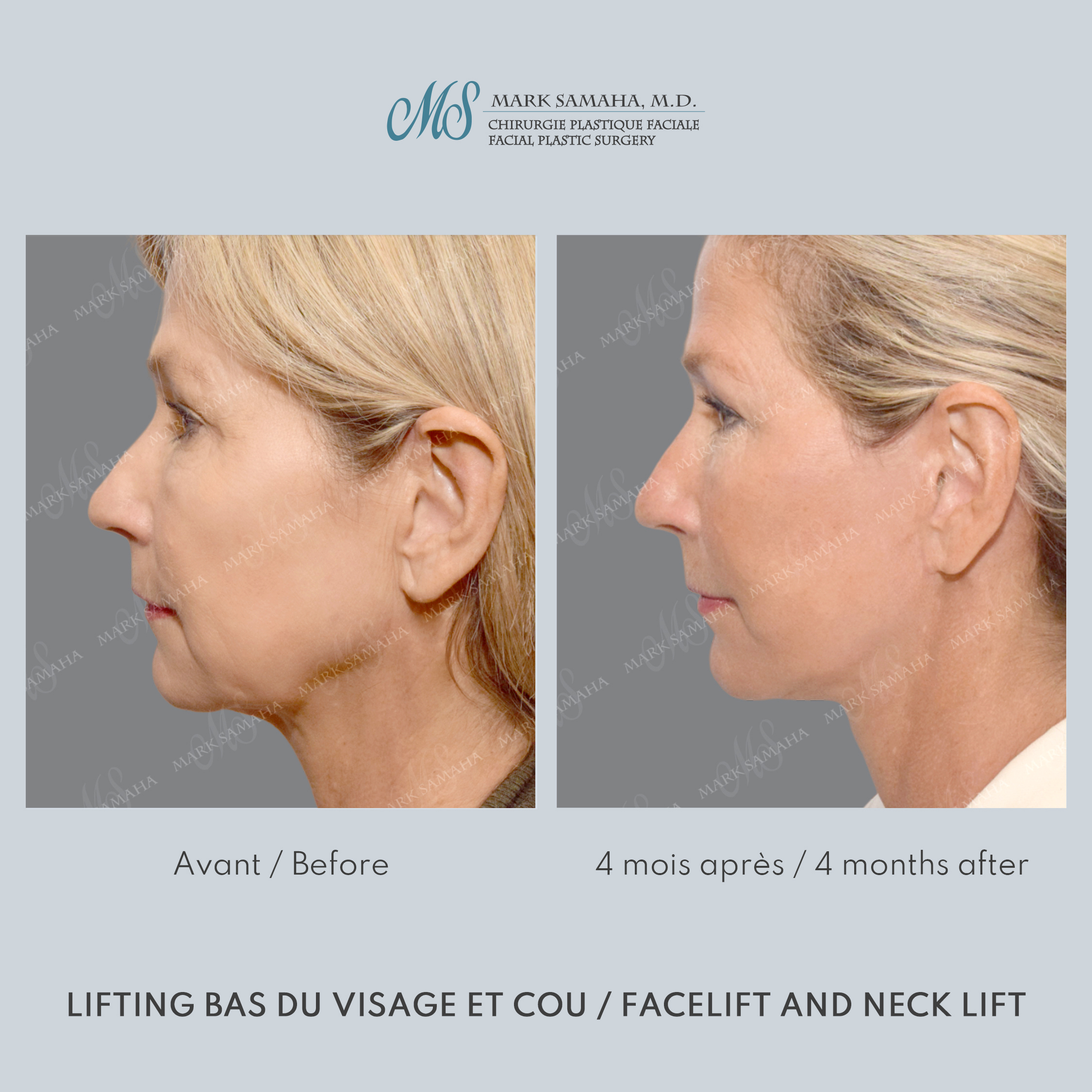 Before & After Lifting du visage / Cou - Facelift / Necklift Case 251 View #2 Detail View in Montreal, QC