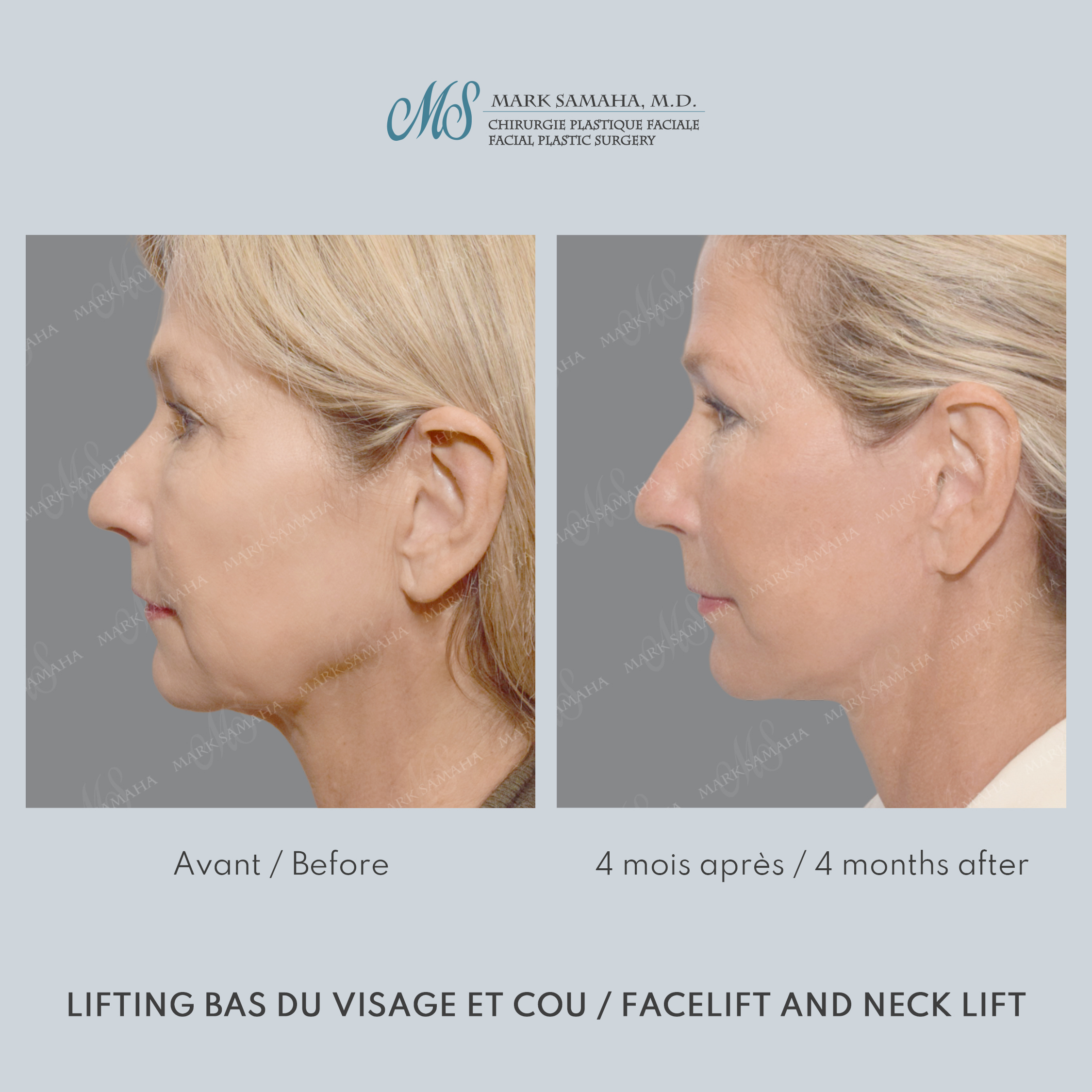 Before & After Lifting du visage / Cou - Facelift / Necklift Case 251 View #2 View in Montreal, QC