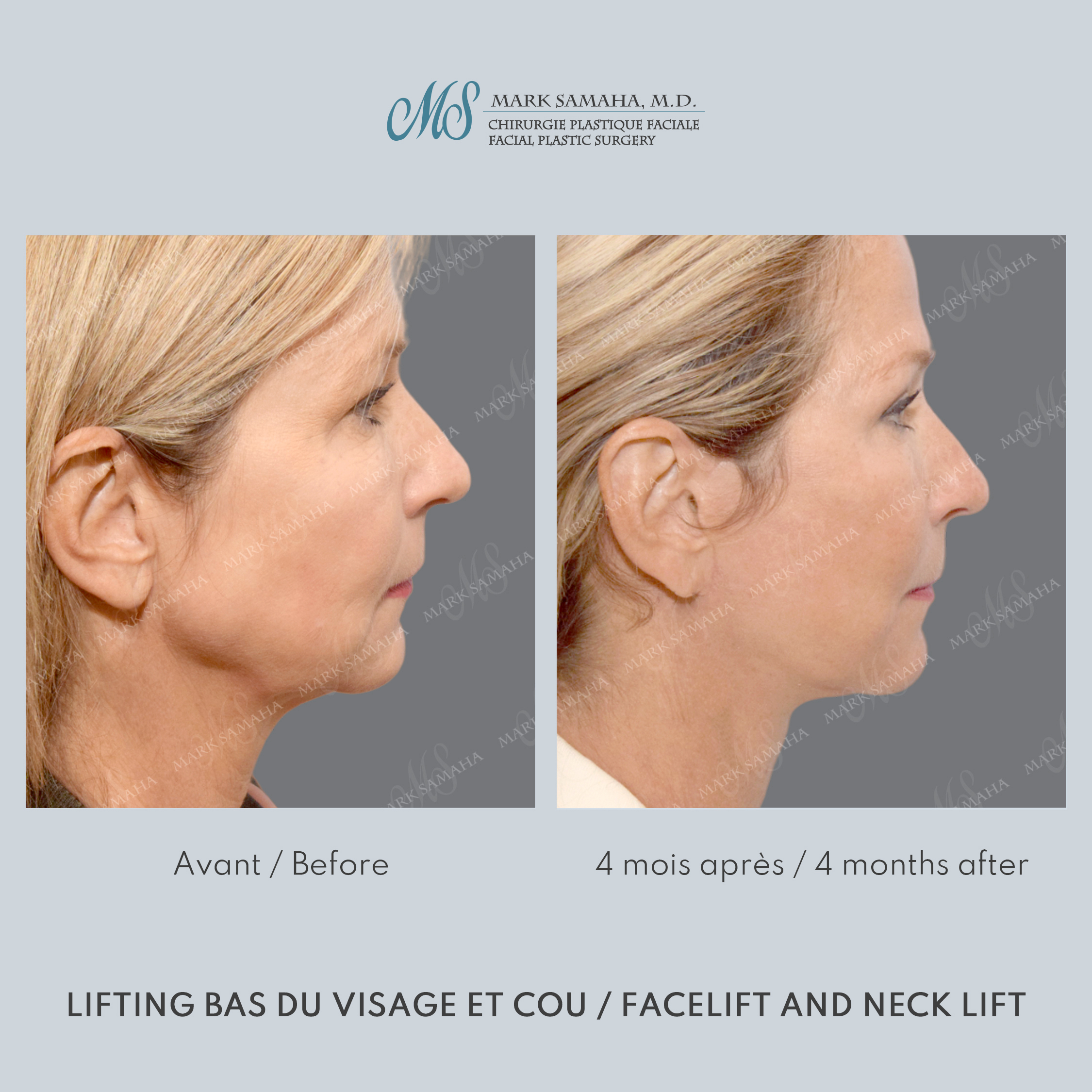 Before & After Lifting du visage / Cou - Facelift / Necklift Case 251 View #3 Detail View in Montreal, QC