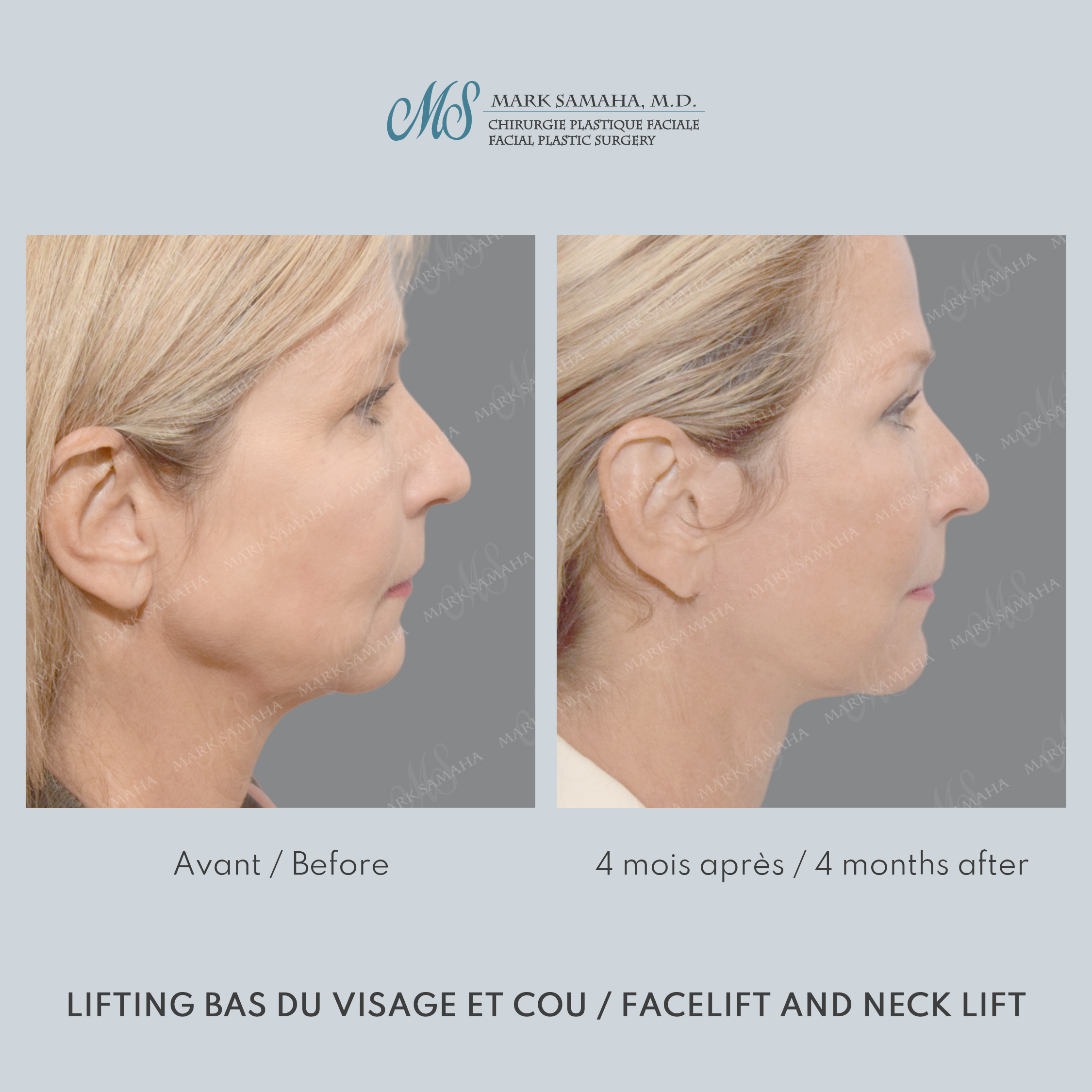 Before & After Lifting du visage / Cou - Facelift / Necklift Case 251 View #3 View in Montreal, QC