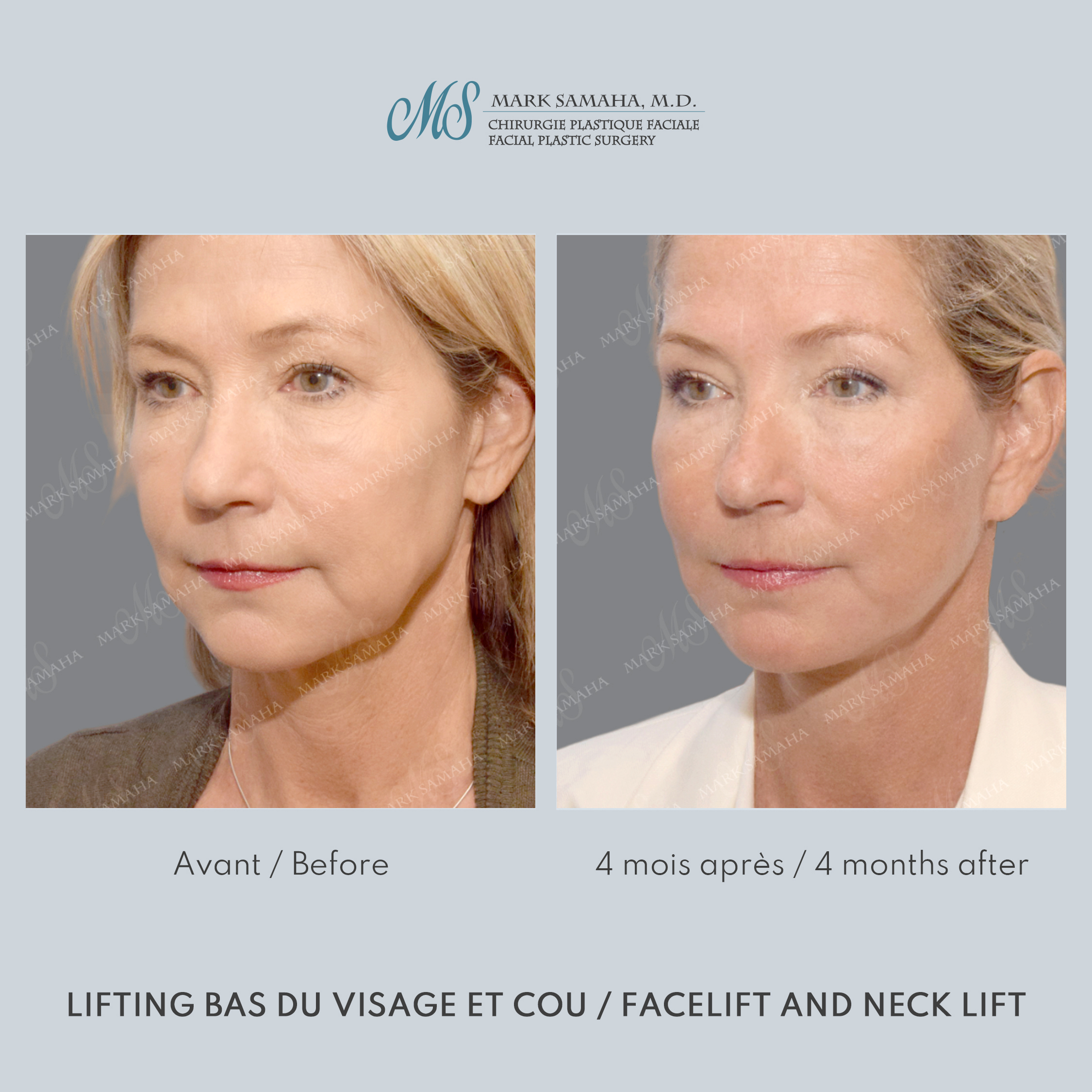Before & After Lifting du visage / Cou - Facelift / Necklift Case 251 View #4 Detail View in Montreal, QC