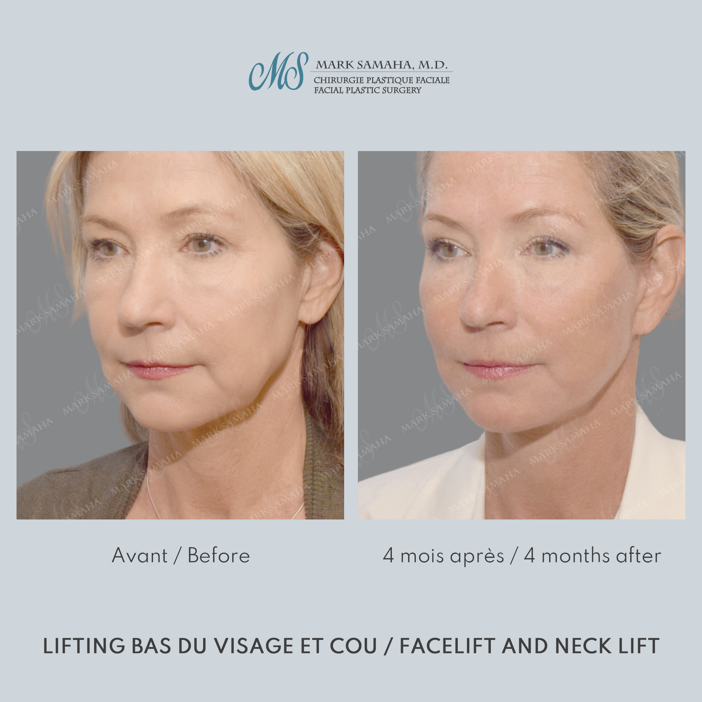 Before & After Lifting du visage / Cou - Facelift / Necklift Case 251 View #4 View in Montreal, QC