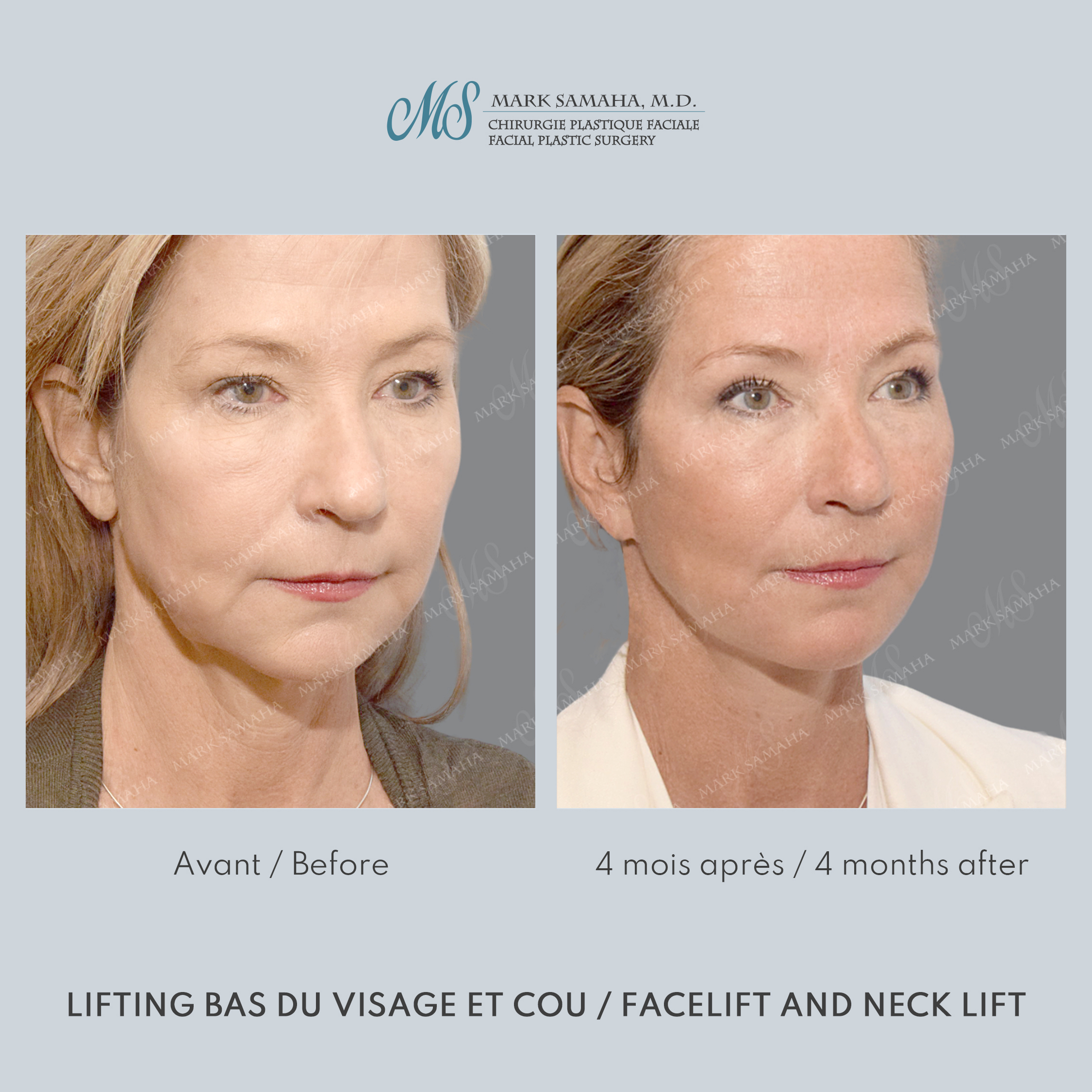 Before & After Lifting du visage / Cou - Facelift / Necklift Case 251 View #5 Detail View in Montreal, QC