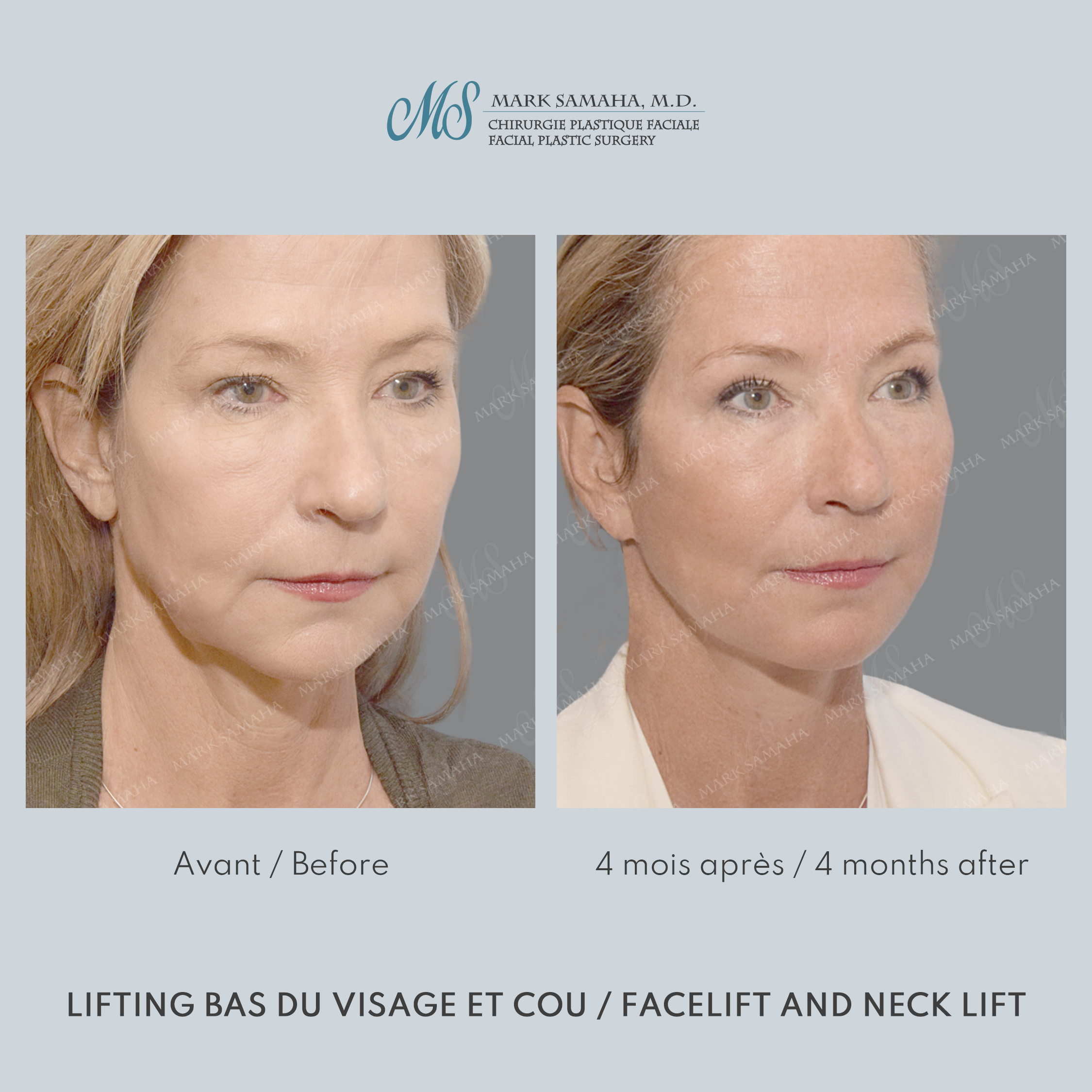 Before & After Lifting du visage / Cou - Facelift / Necklift Case 251 View #5 View in Montreal, QC