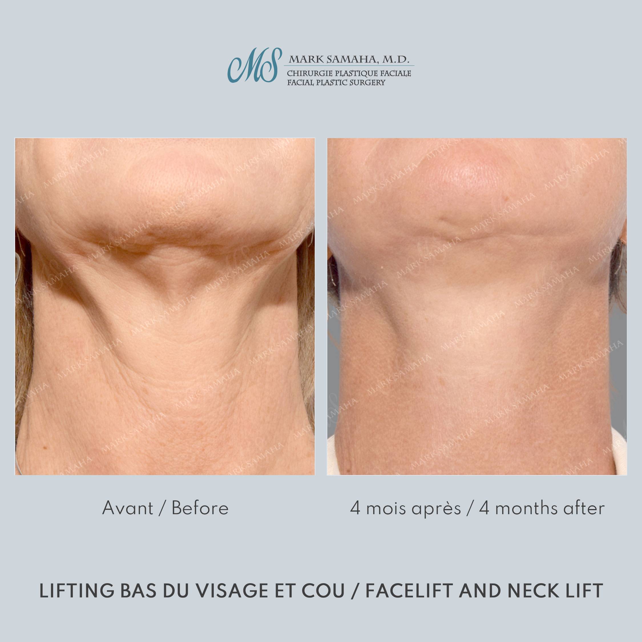 Before & After Lifting du visage / Cou - Facelift / Necklift Case 251 View #6 Detail View in Montreal, QC