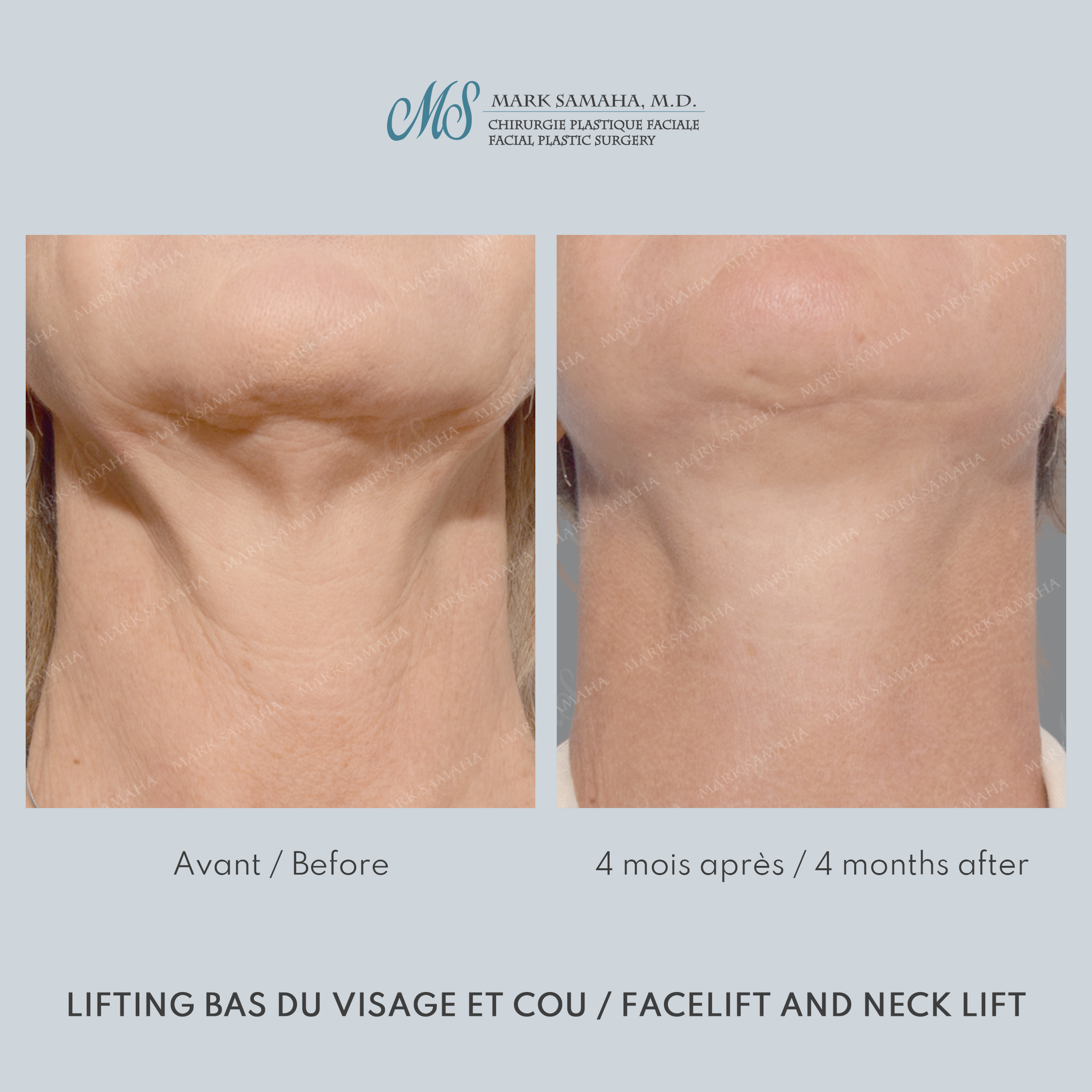 Before & After Lifting du visage / Cou - Facelift / Necklift Case 251 View #6 View in Montreal, QC