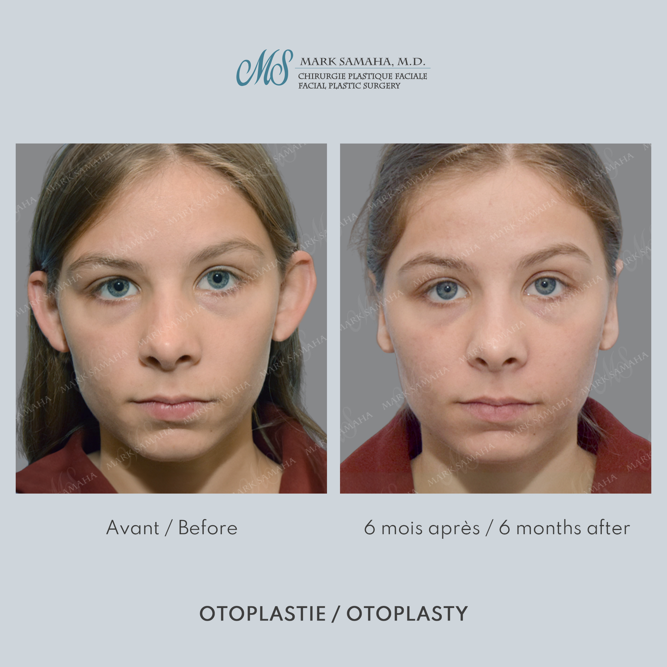 Before & After Otoplastie / Ear Surgery Case 229 View #1 View in Montreal, QC