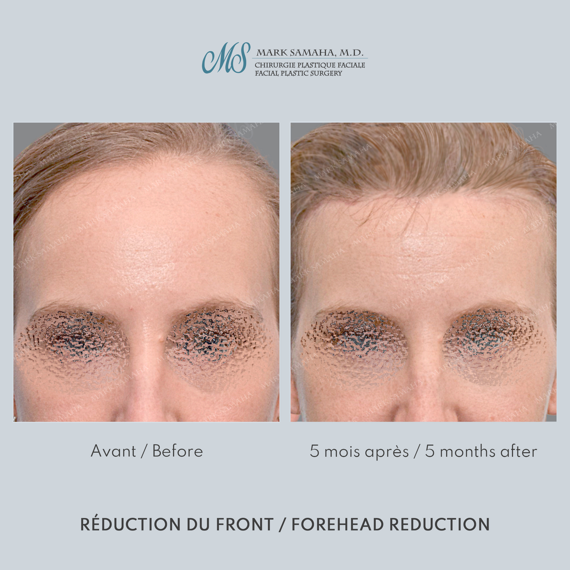 Before & After Réduction du front / Forehead Reduction Case 253 View #1 Detail View in Montreal, QC