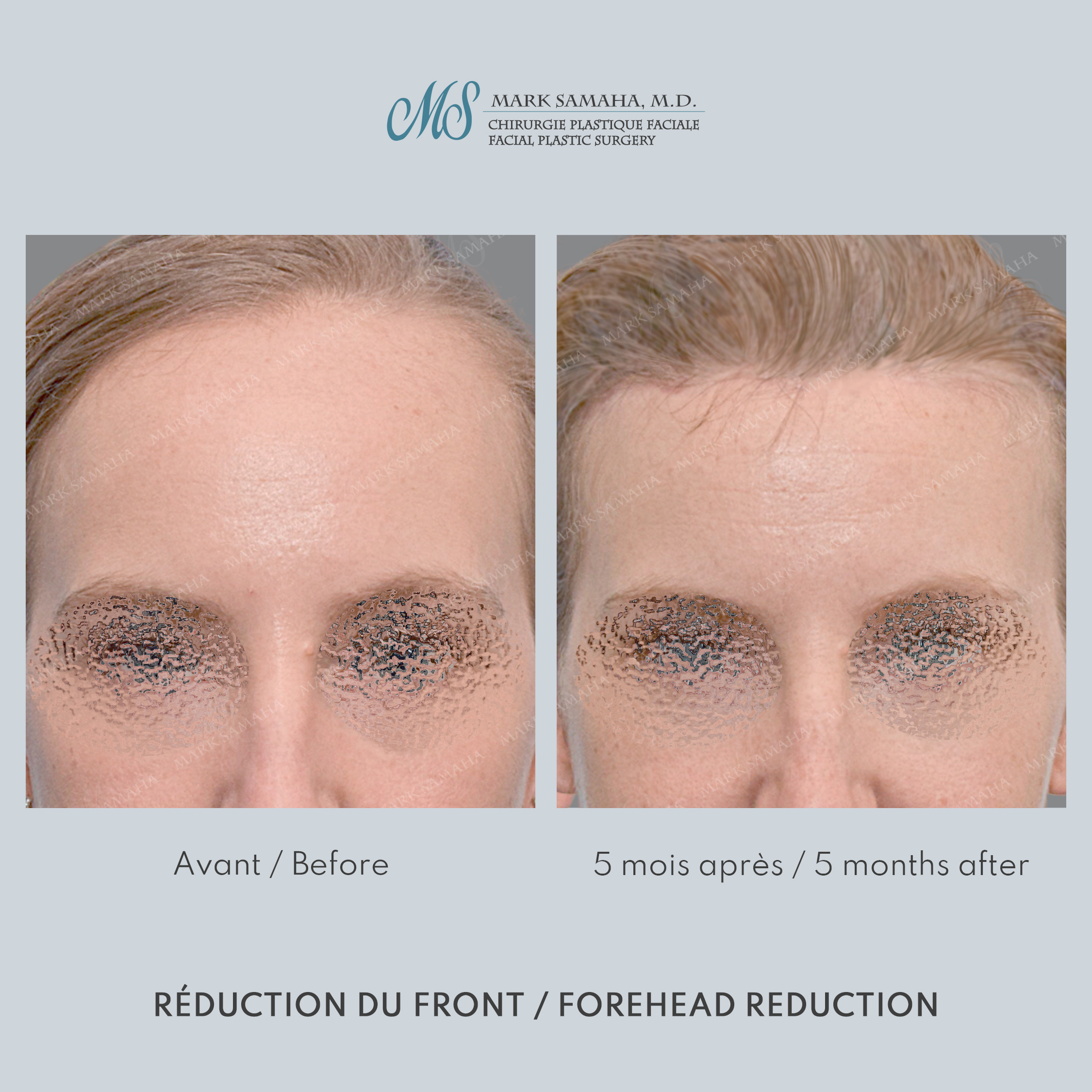 Before & After Réduction du front / Forehead Reduction Case 253 View #1 View in Montreal, QC