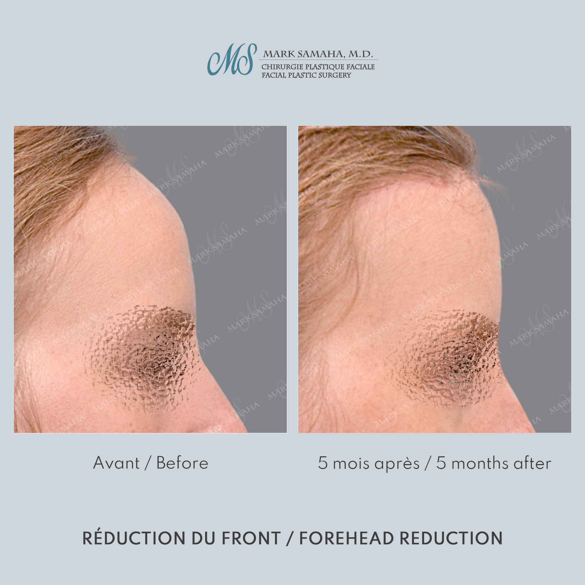 Before & After Réduction du front / Forehead Reduction Case 253 View #2 Detail View in Montreal, QC
