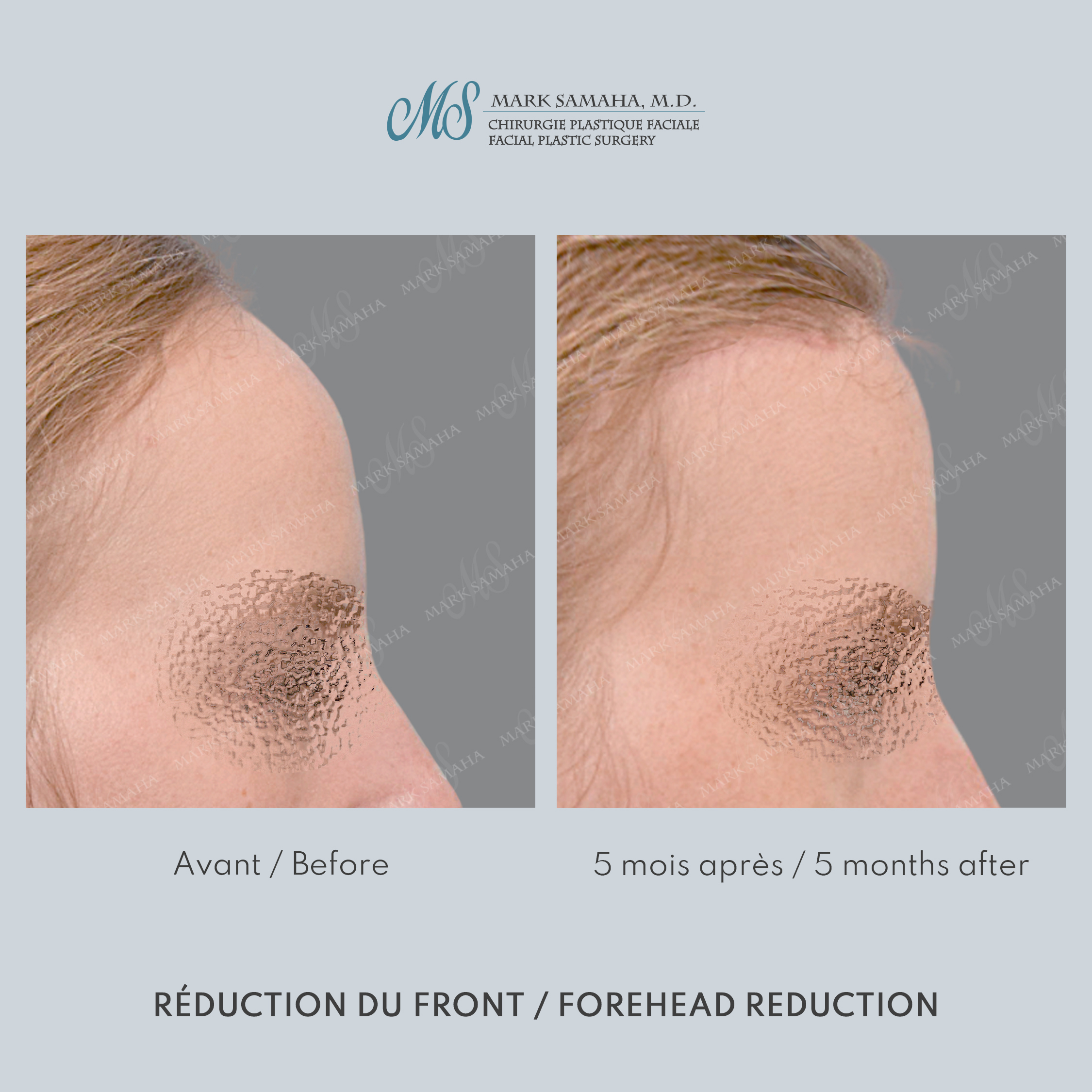 Before & After Réduction du front / Forehead Reduction Case 253 View #2 View in Montreal, QC