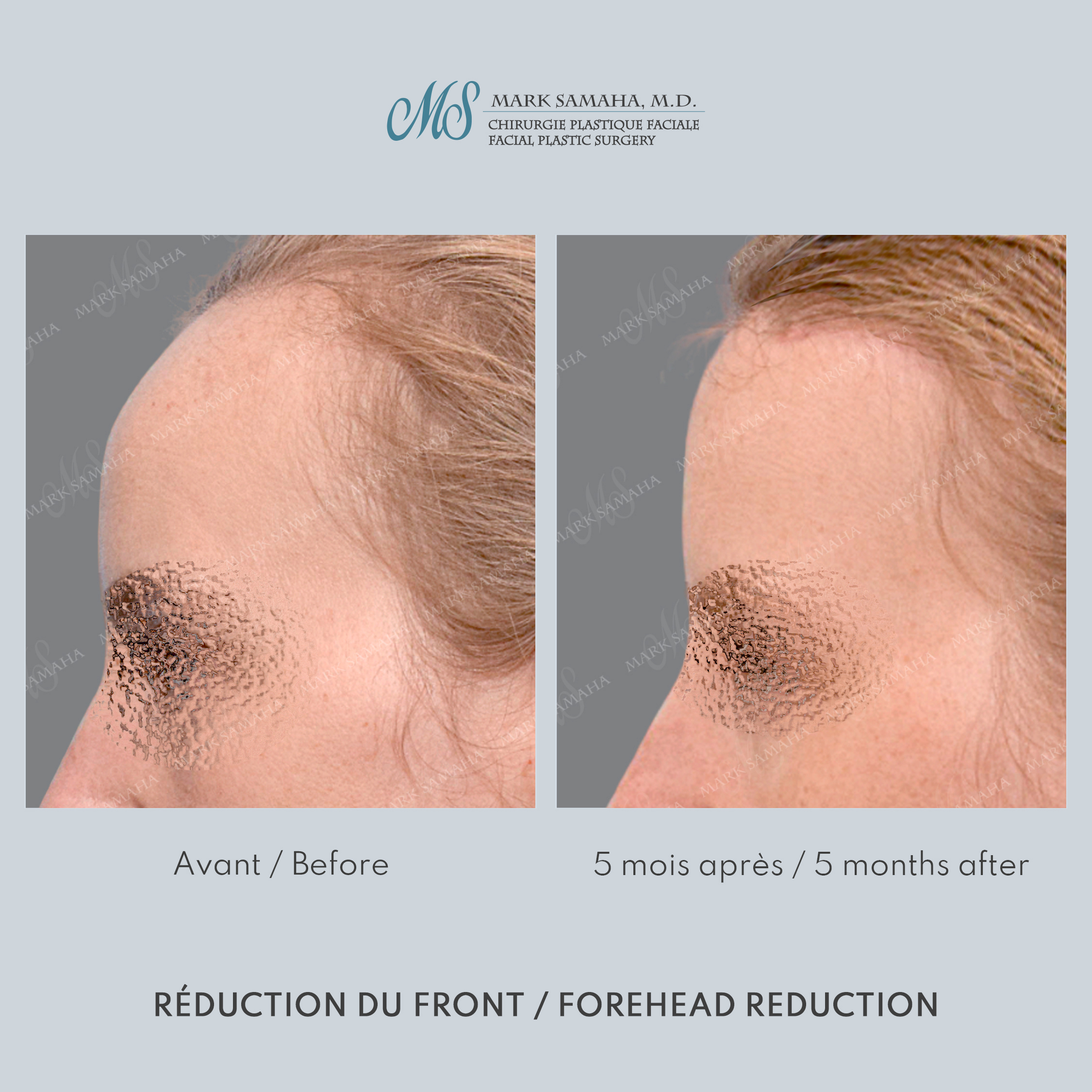 Before & After Réduction du front / Forehead Reduction Case 253 View #3 Detail View in Montreal, QC