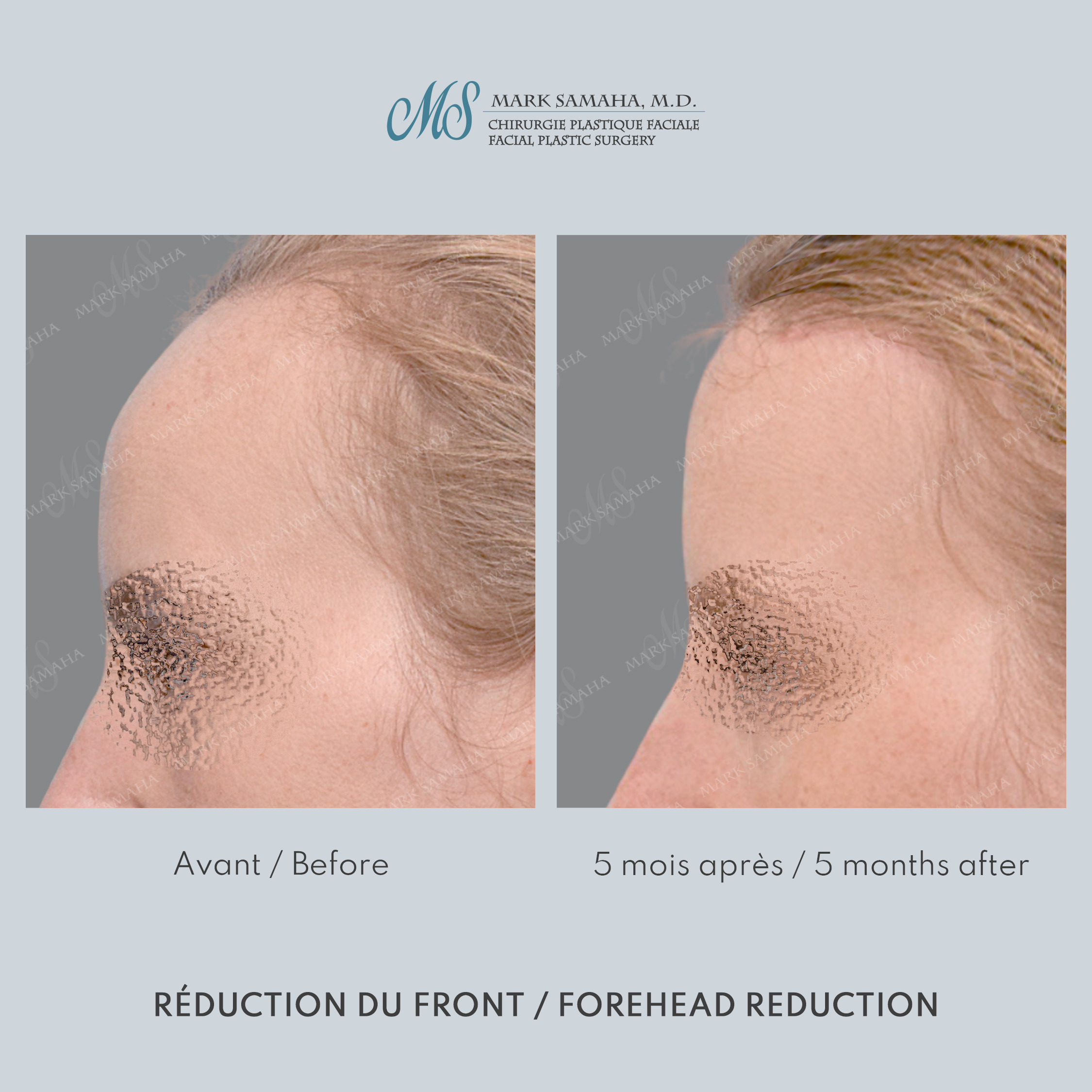 Before & After Réduction du front / Forehead Reduction Case 253 View #3 View in Montreal, QC