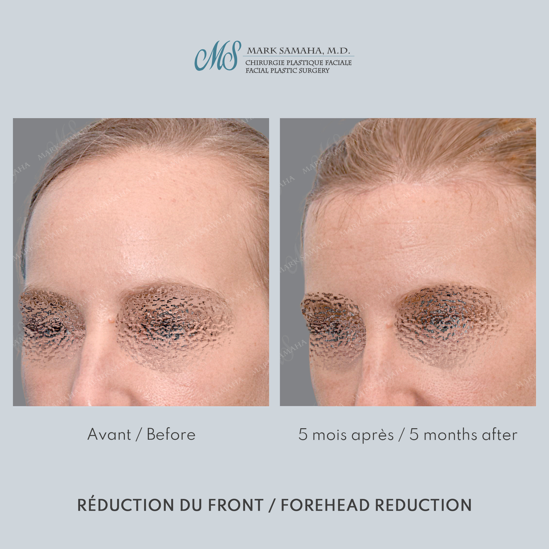 Before & After Réduction du front / Forehead Reduction Case 253 View #4 Detail View in Montreal, QC
