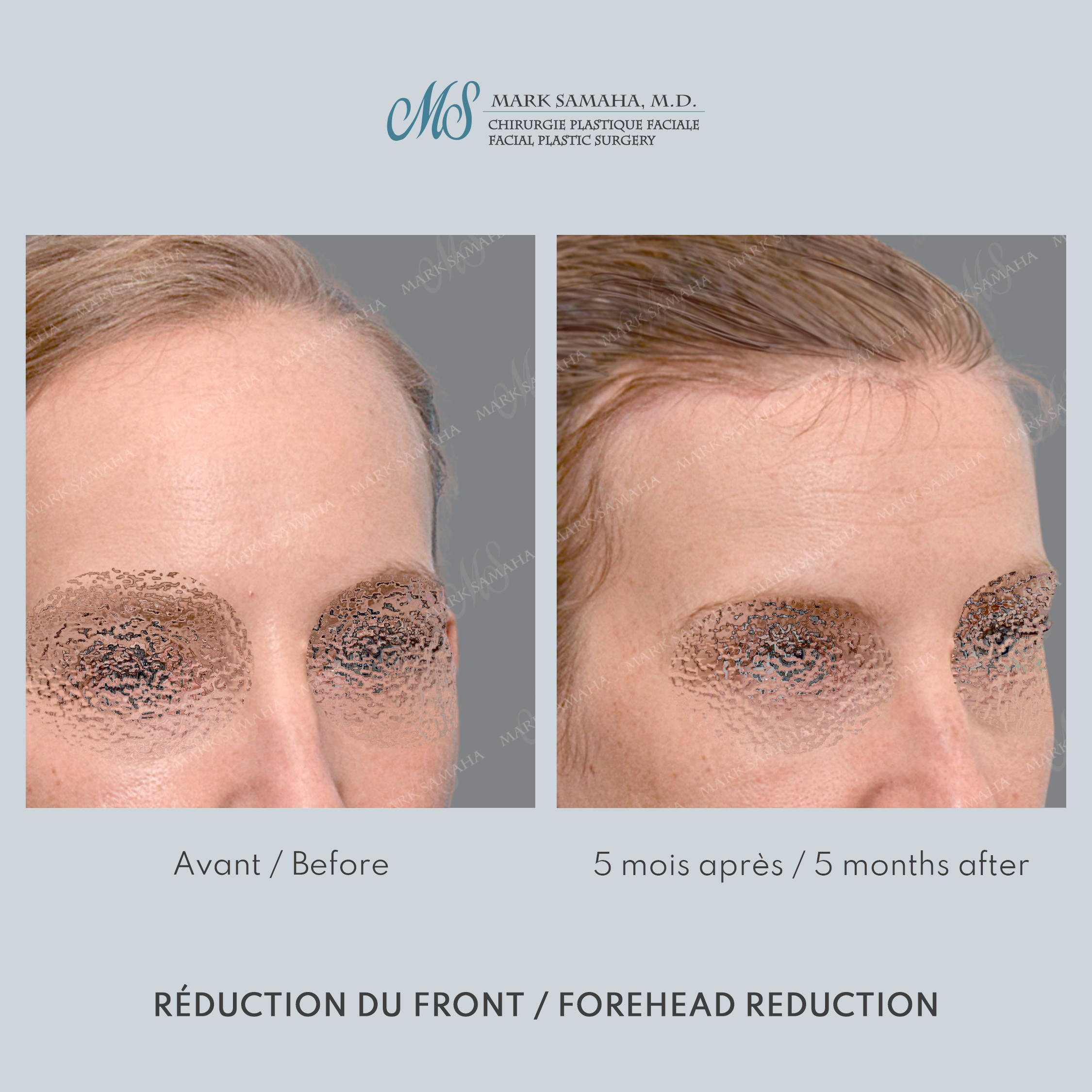 Before & After Réduction du front / Forehead Reduction Case 253 View #5 Detail View in Montreal, QC