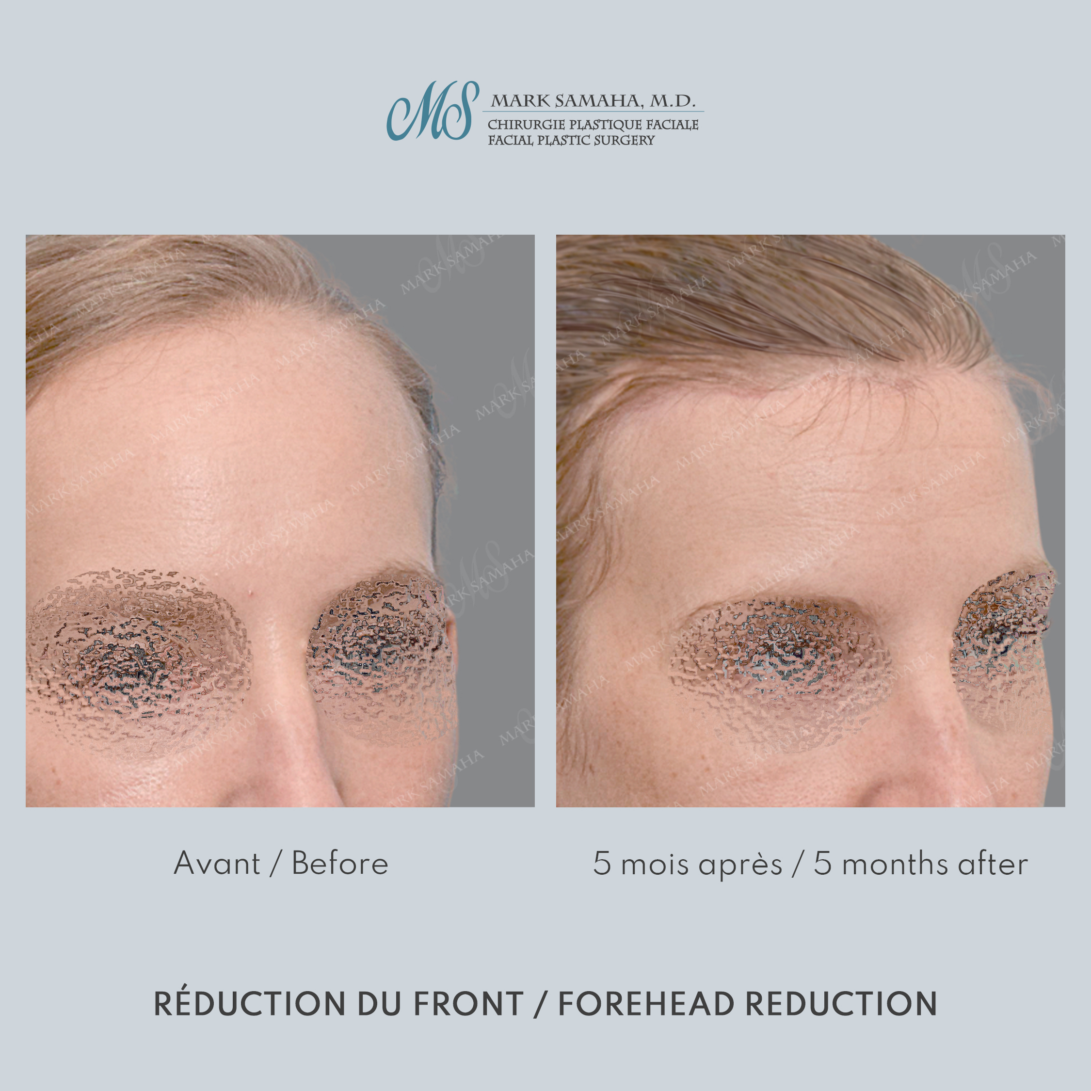 Before & After Réduction du front / Forehead Reduction Case 253 View #5 View in Montreal, QC