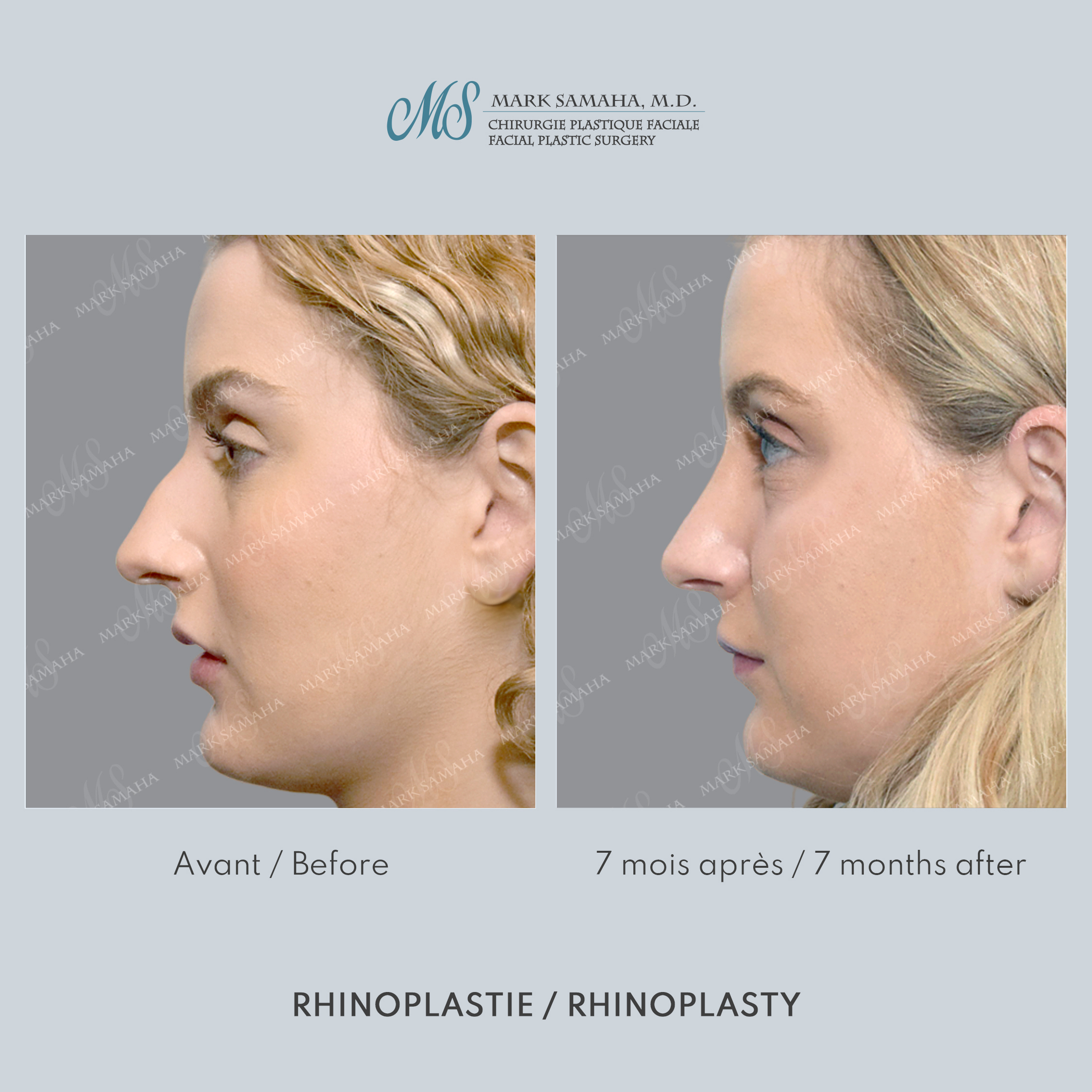 Before & After Rhinoplastie / Rhinoplasty Case 211 View #1 Detail View in Montreal, QC