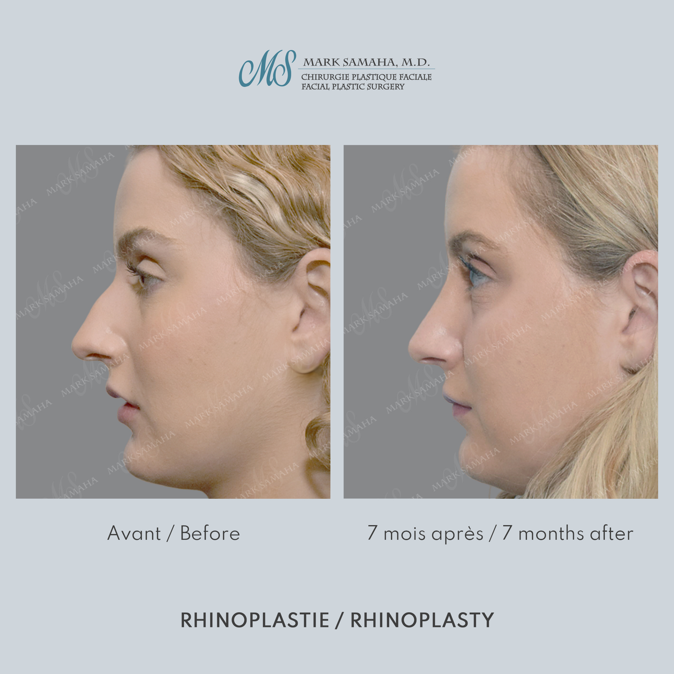 Before & After Rhinoplastie / Rhinoplasty Case 211 View #1 View in Montreal, QC