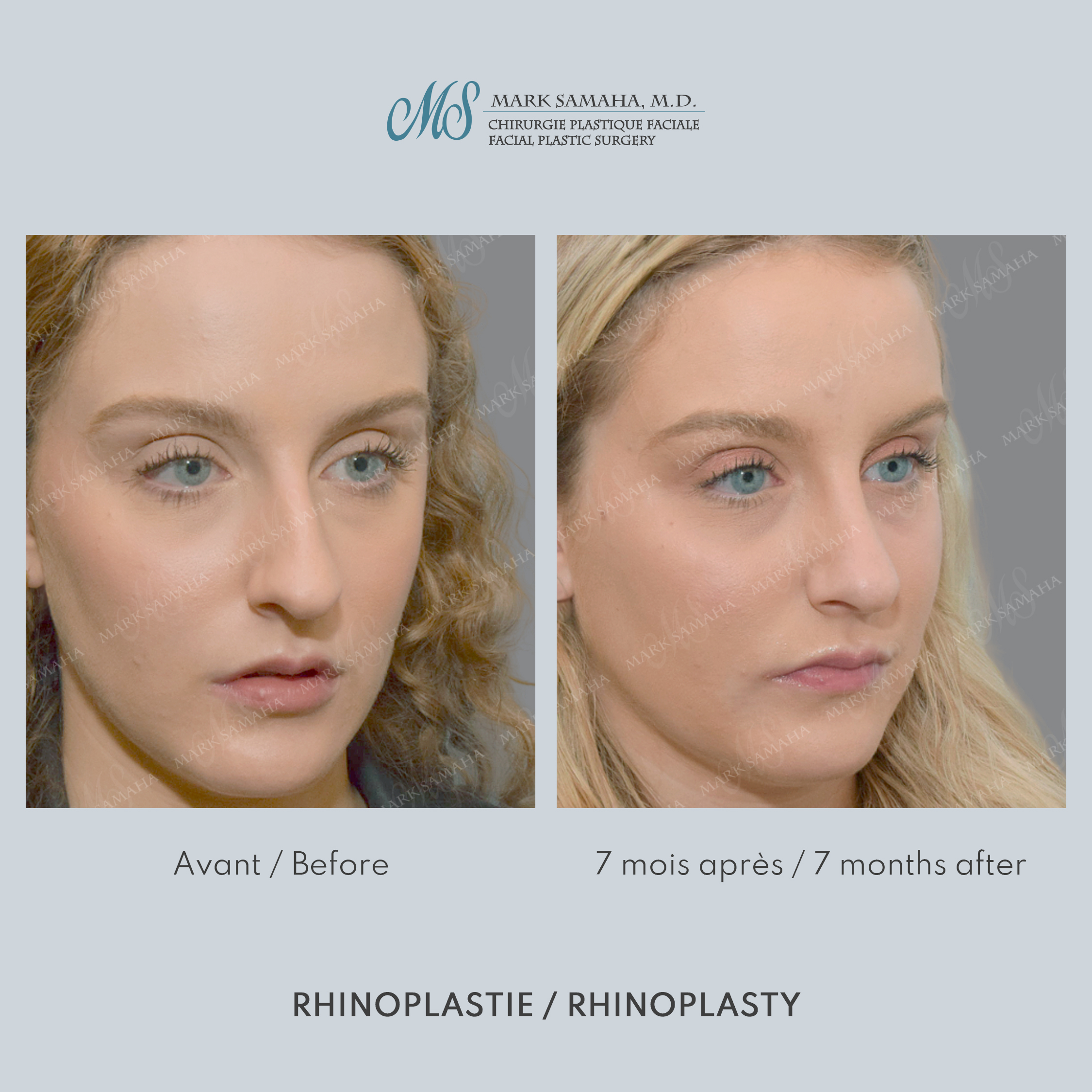 Before & After Rhinoplastie / Rhinoplasty Case 211 View #2 View in Montreal, QC