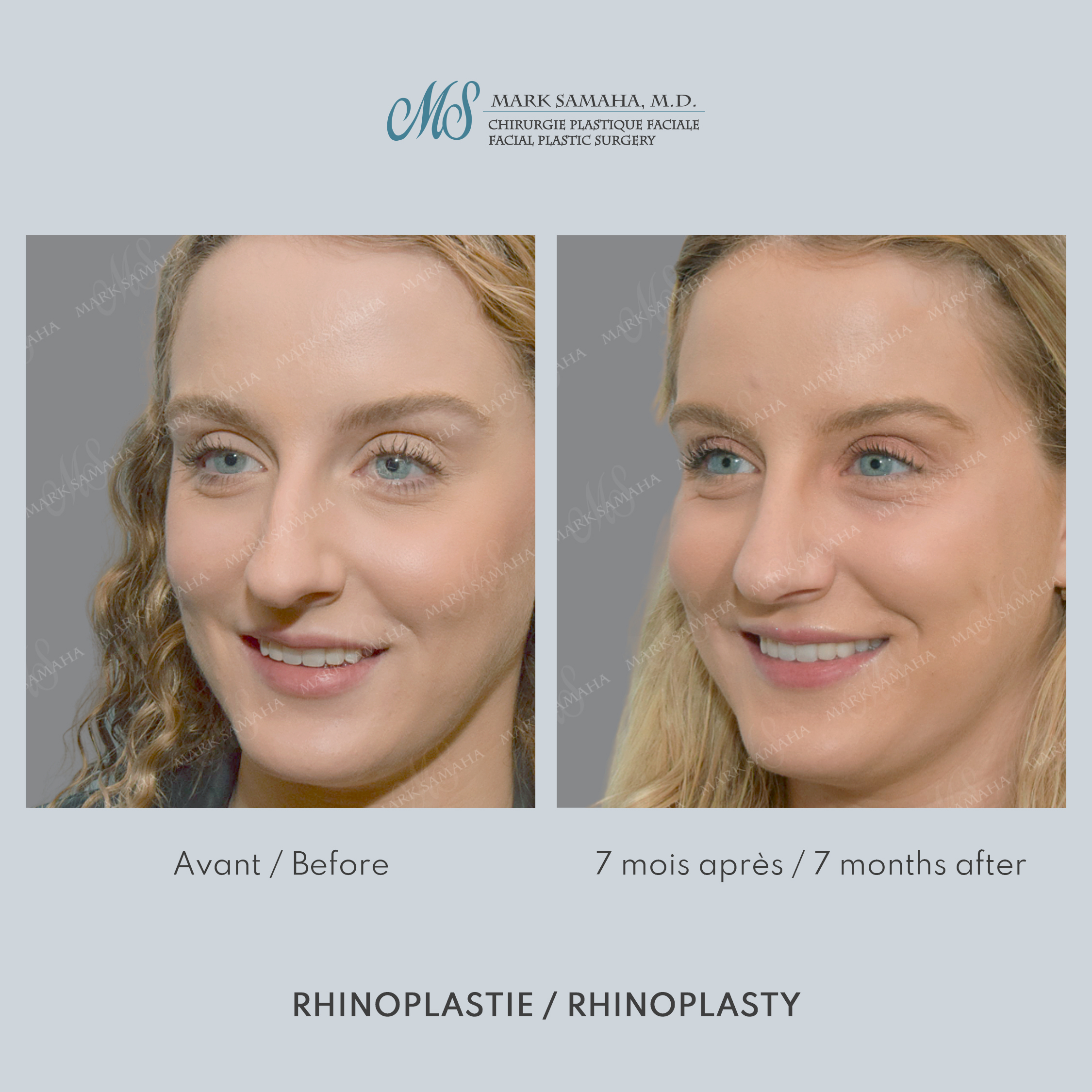 Before & After Rhinoplastie / Rhinoplasty Case 211 View #3 View in Montreal, QC