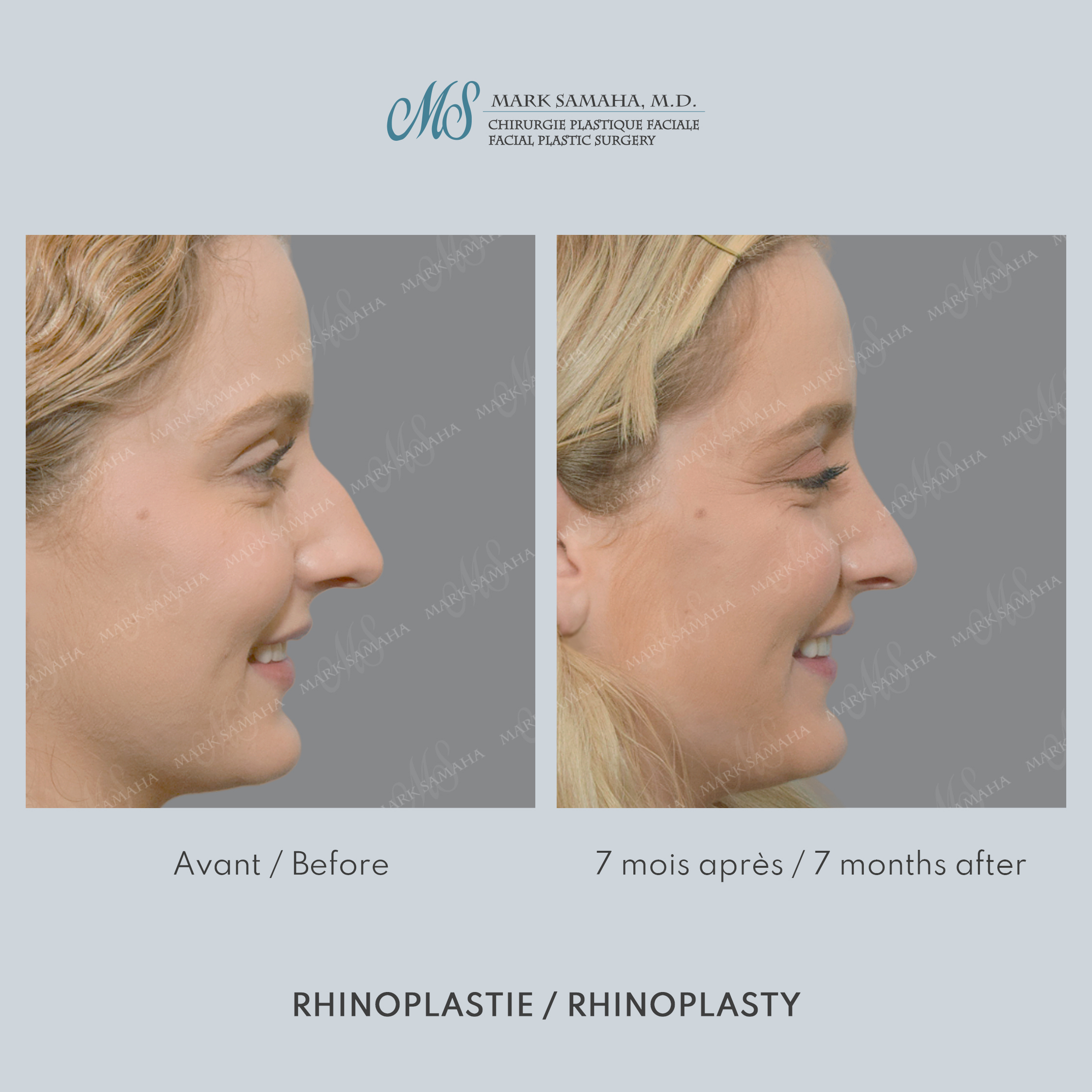 Before & After Rhinoplastie / Rhinoplasty Case 211 View #4 View in Montreal, QC
