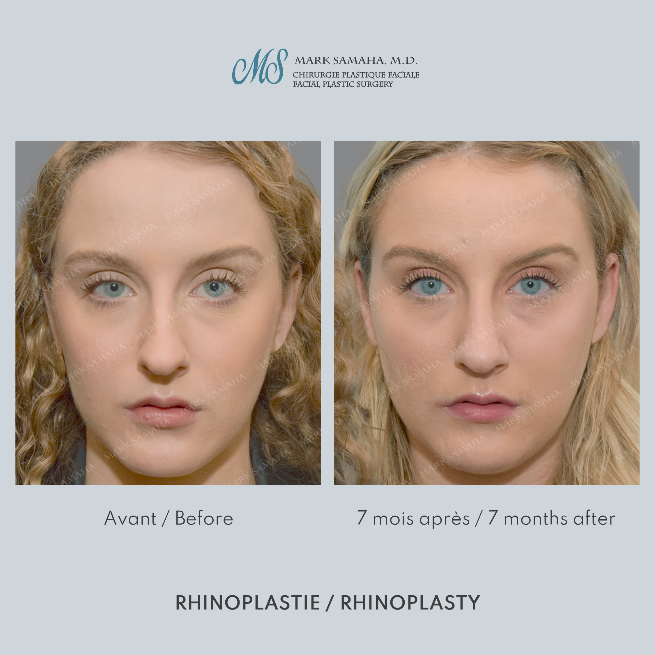Before & After Rhinoplastie / Rhinoplasty Case 211 View #5 View in Montreal, QC
