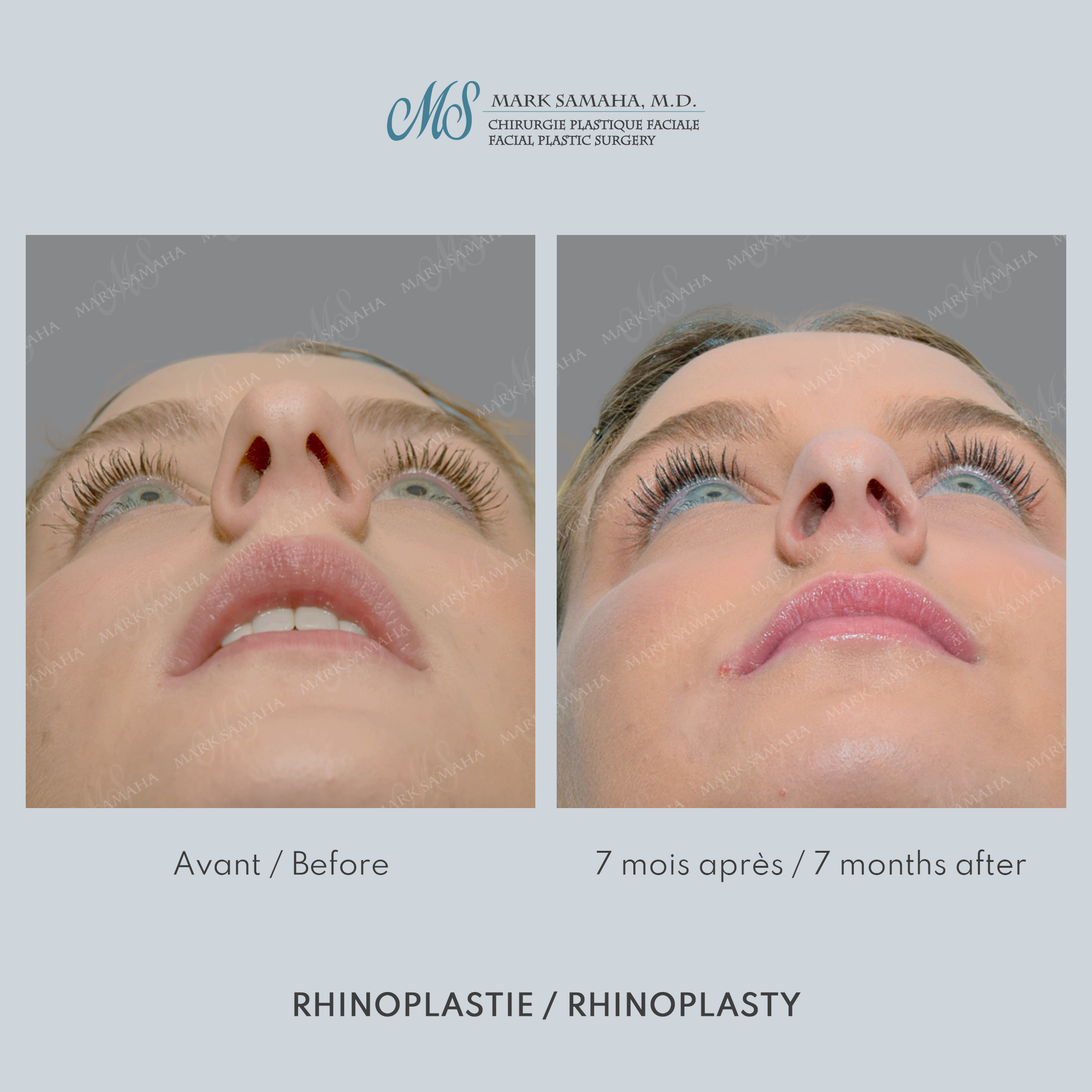 Before & After Rhinoplastie / Rhinoplasty Case 211 View #6 View in Montreal, QC