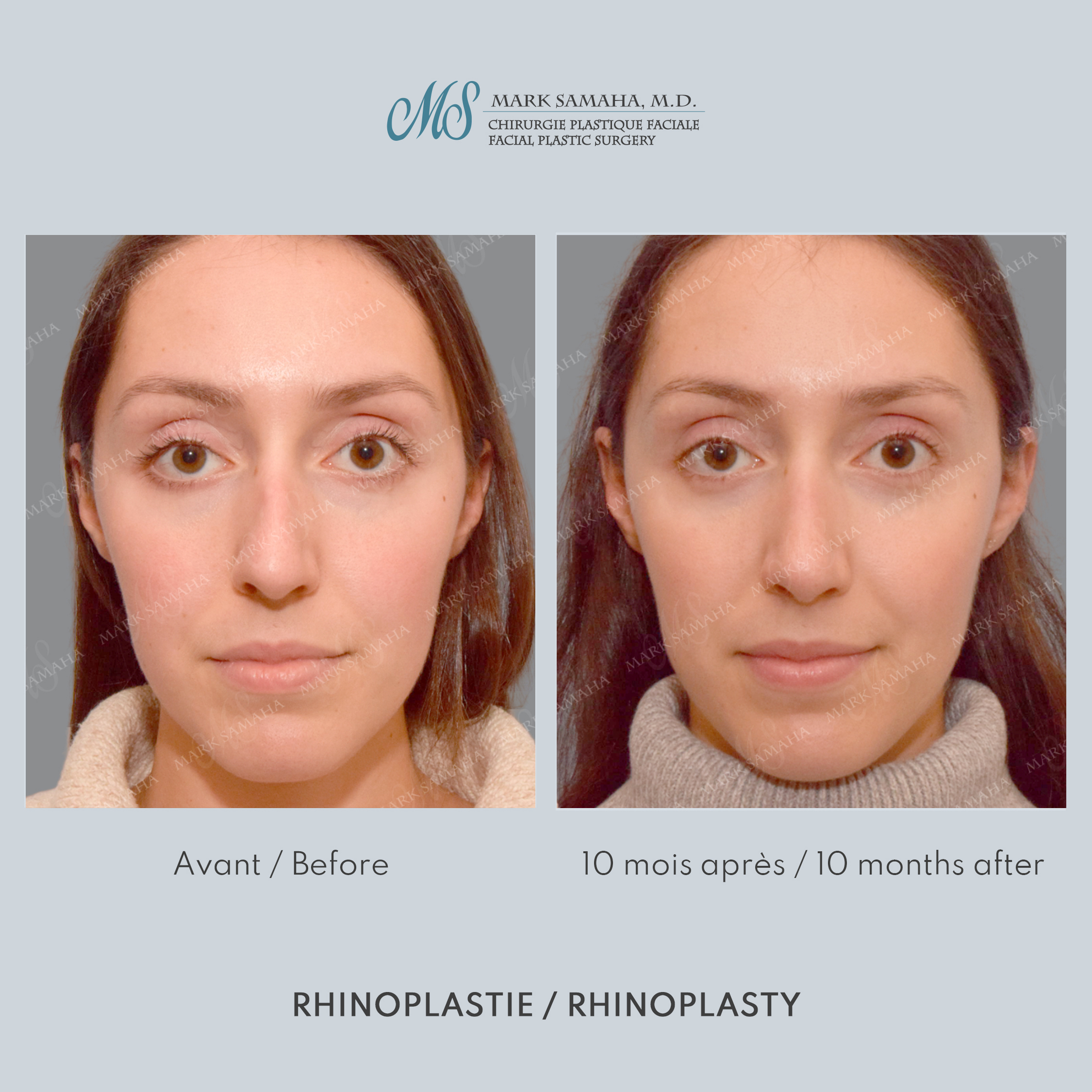 Before & After Rhinoplastie / Rhinoplasty Case 212 View #1 Detail View in Montreal, QC