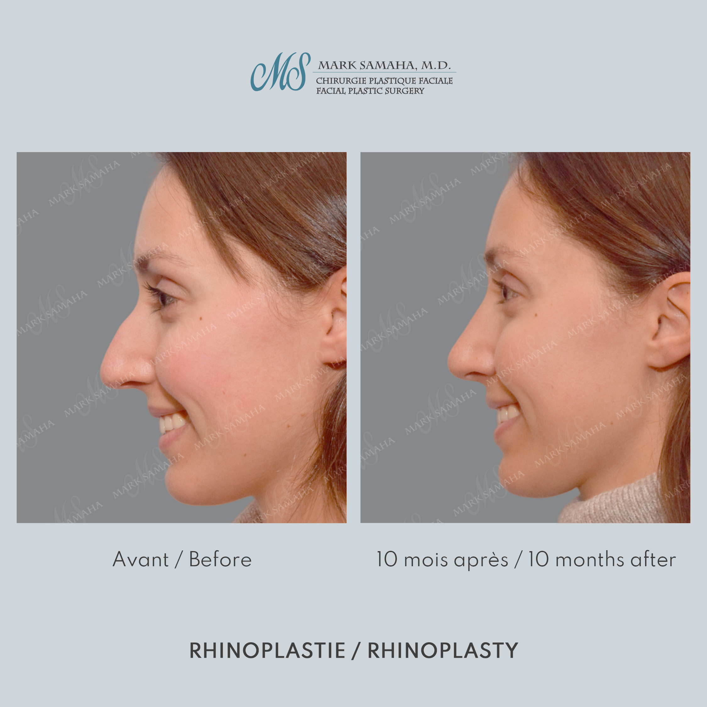 Before & After Rhinoplastie / Rhinoplasty Case 212 View #2 View in Montreal, QC