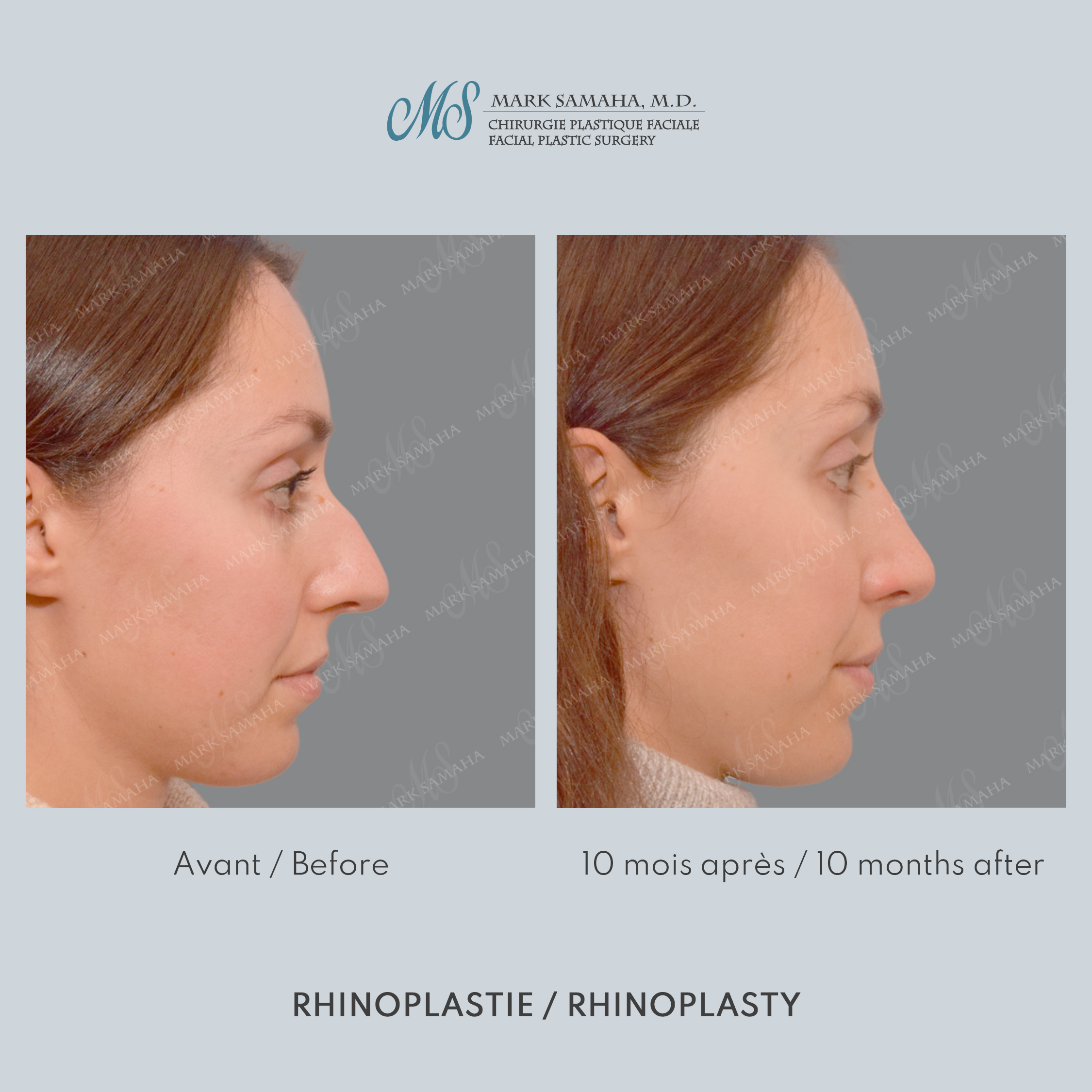Before & After Rhinoplastie / Rhinoplasty Case 212 View #3 View in Montreal, QC