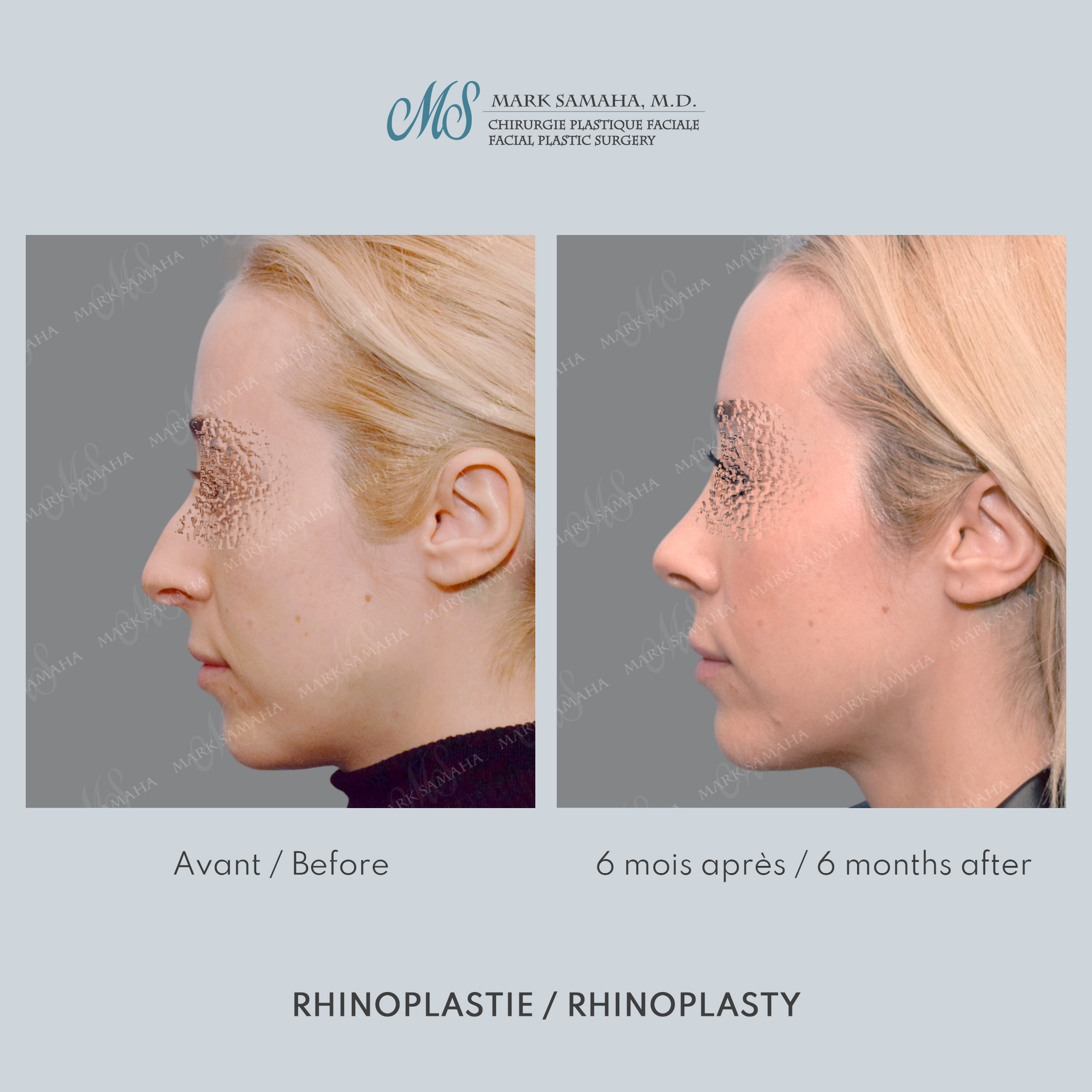 Before & After Rhinoplastie / Rhinoplasty Case 213 View #1 Detail View in Montreal, QC